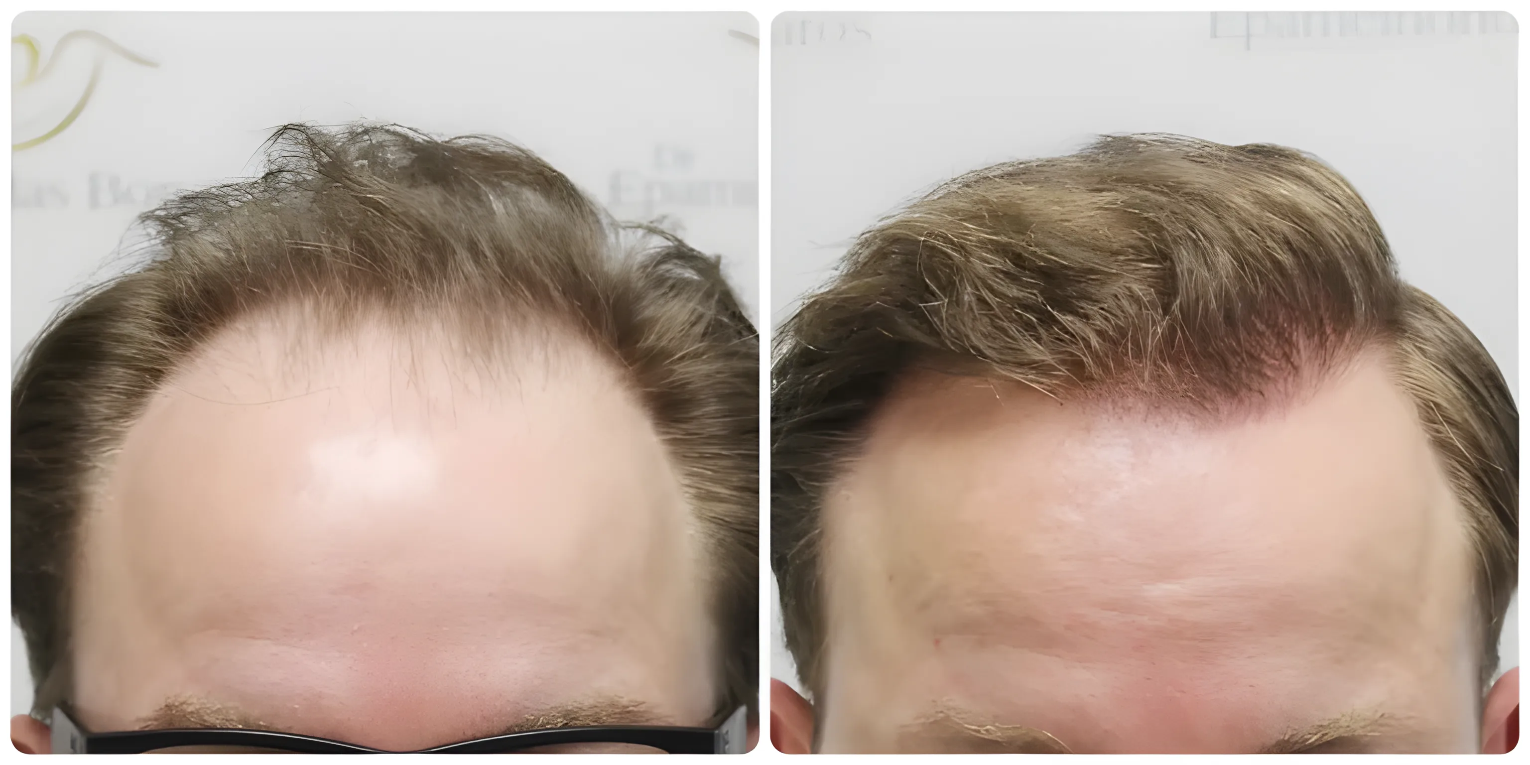 FUE hairline, mid-scalp & crown — 4,081 grafts / 8,253 hairs