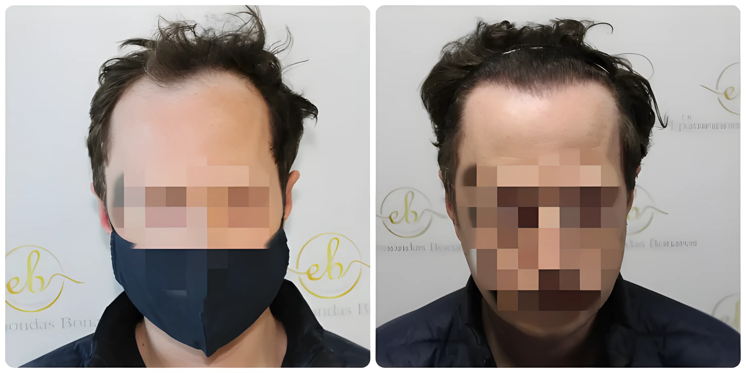 FUE receding hairline — 2,003 grafts / 3,939 hairs