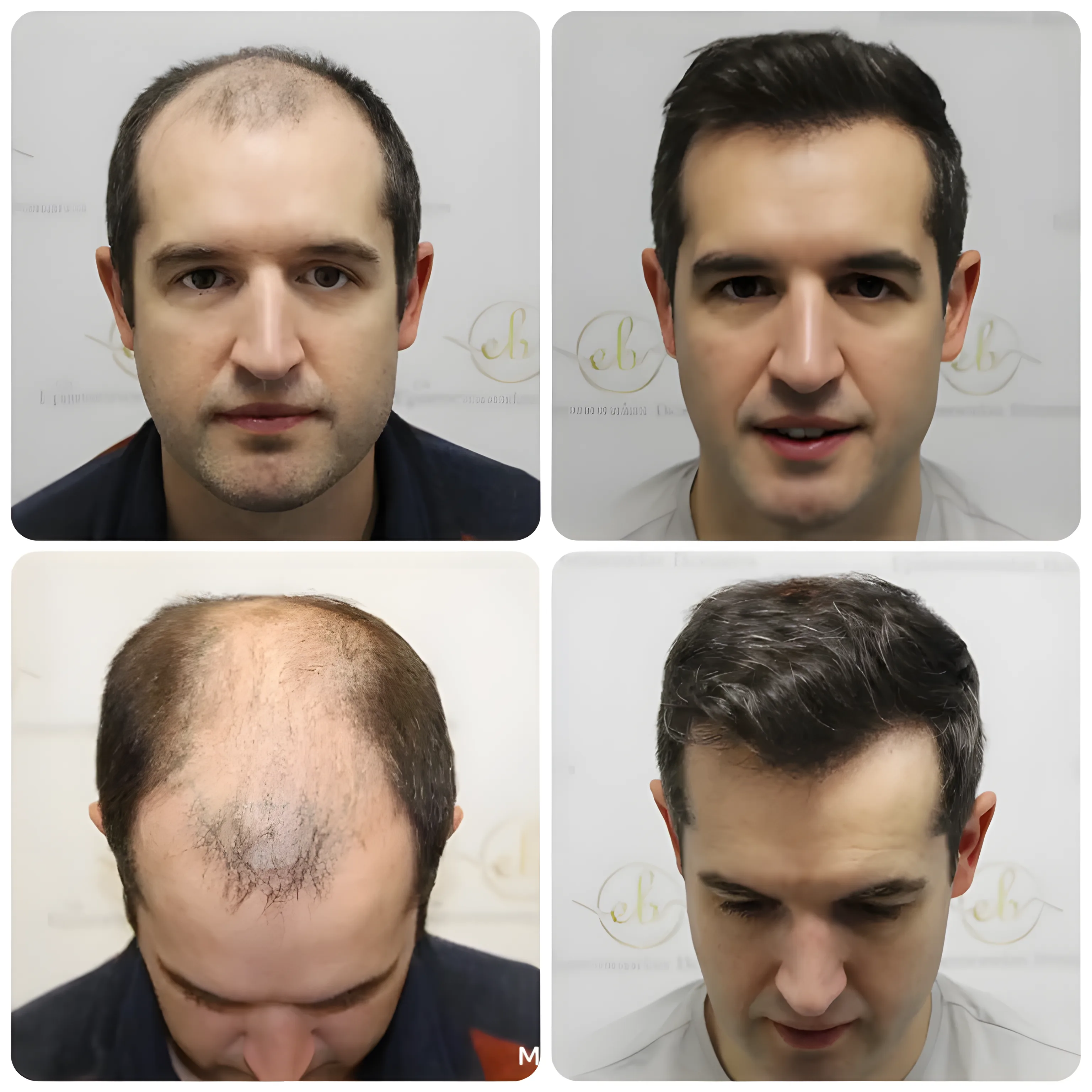 FUE hair transplant — 4,033 grafts / 8,024 hairs
