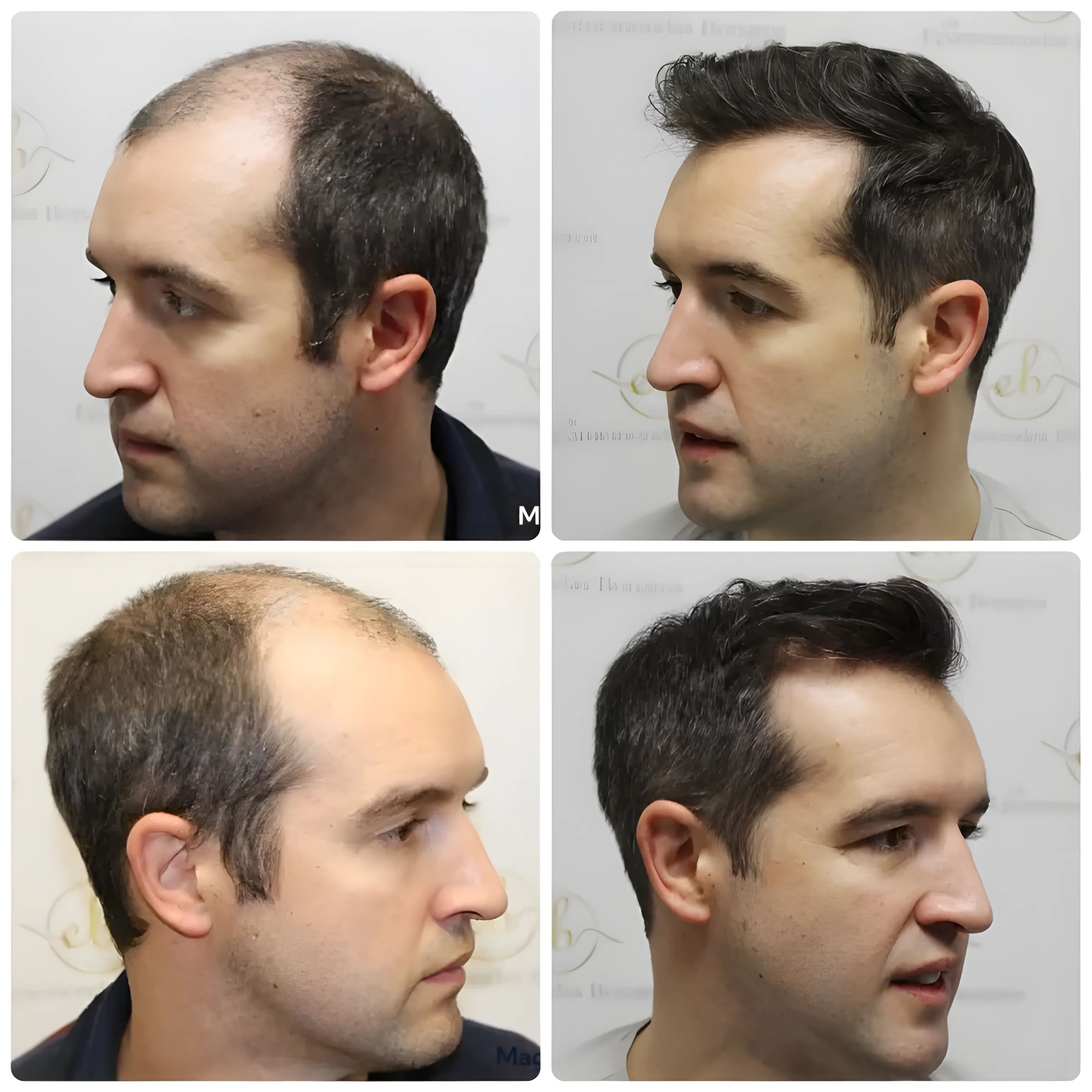 FUE hair transplant — 4,033 grafts / 8,024 hairs