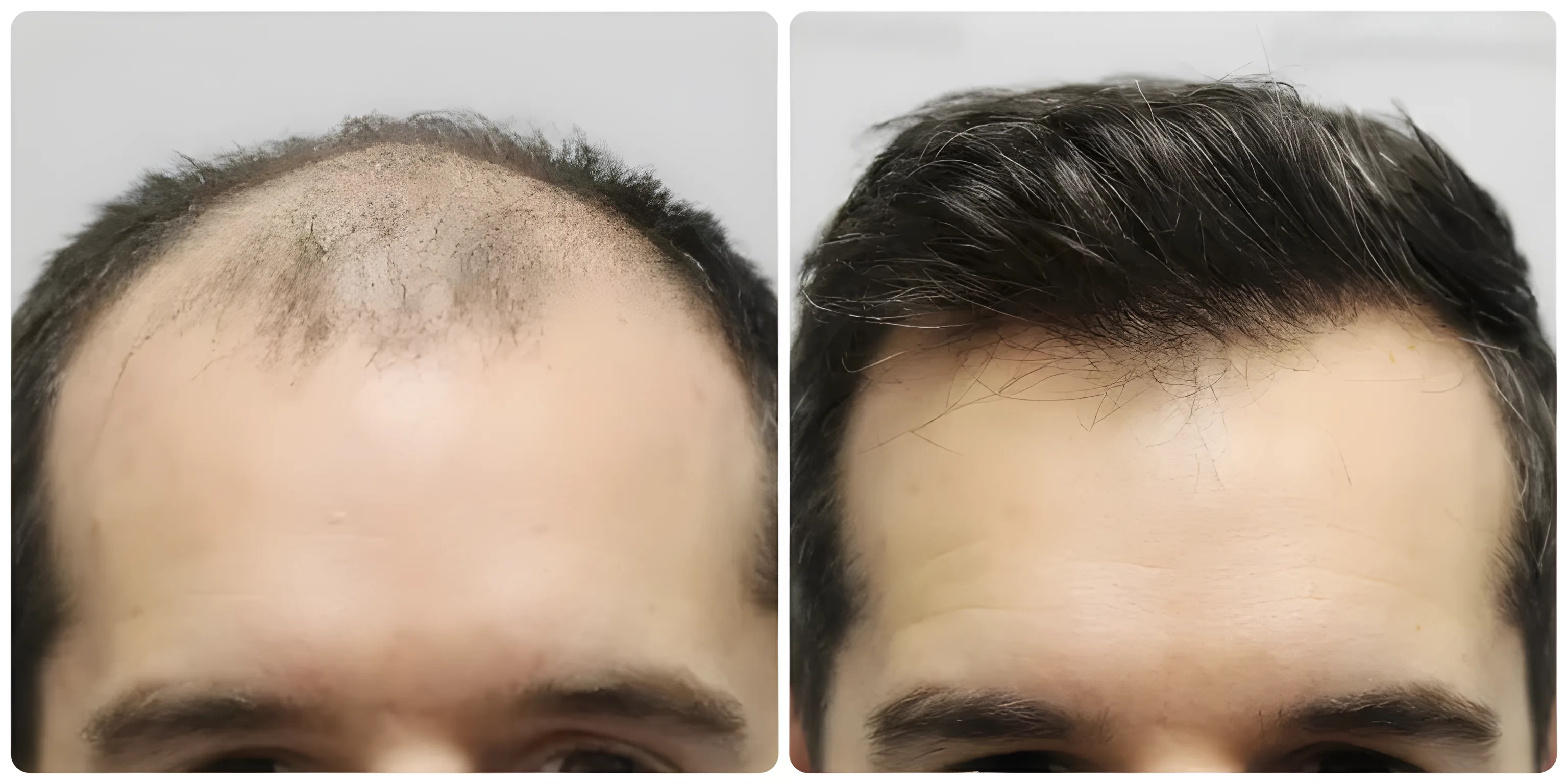 FUE hair transplant — 4,033 grafts / 8,024 hairs