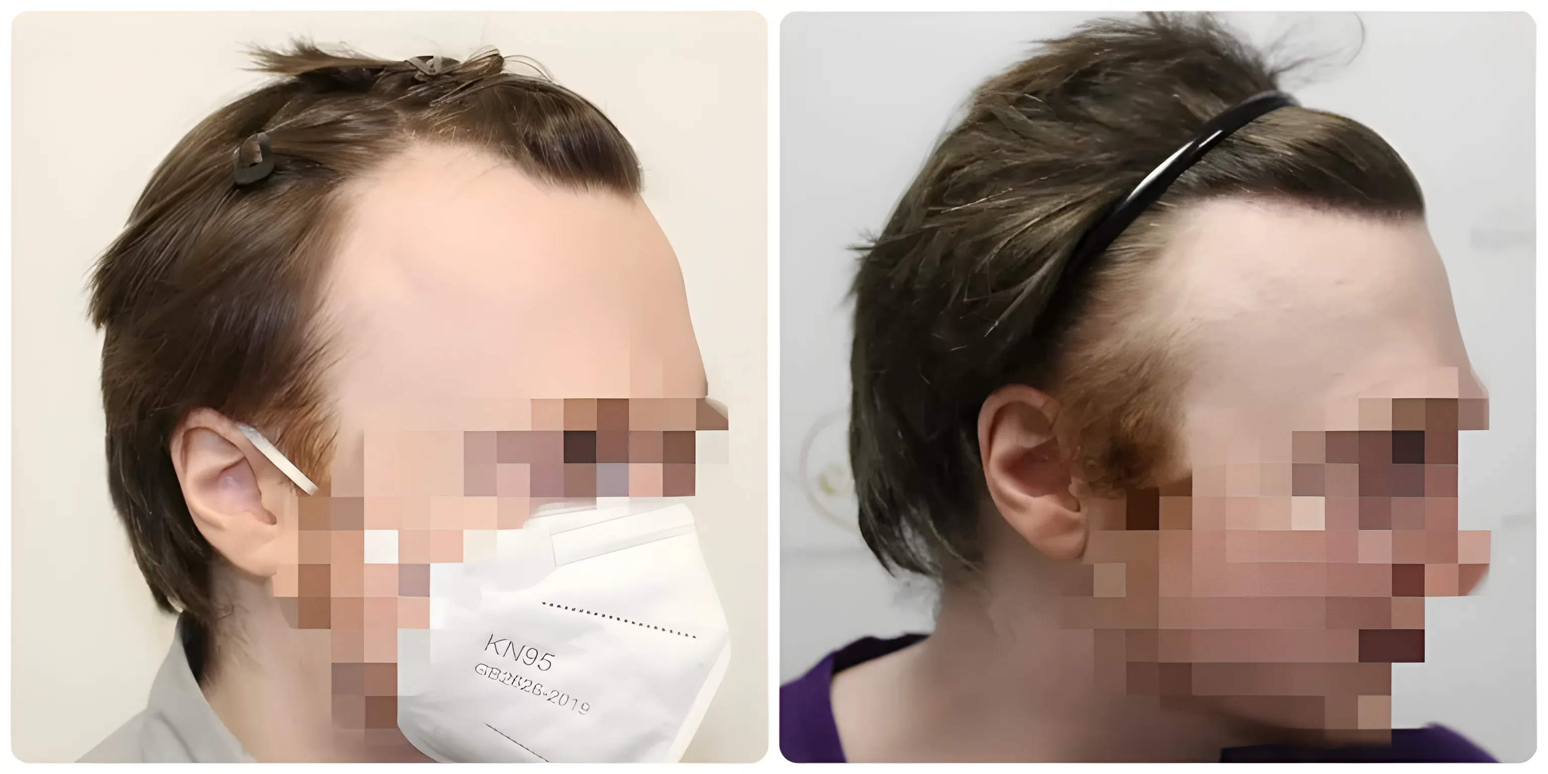 FUE receding hairline — 1,614 grafts / 3,577 hairs