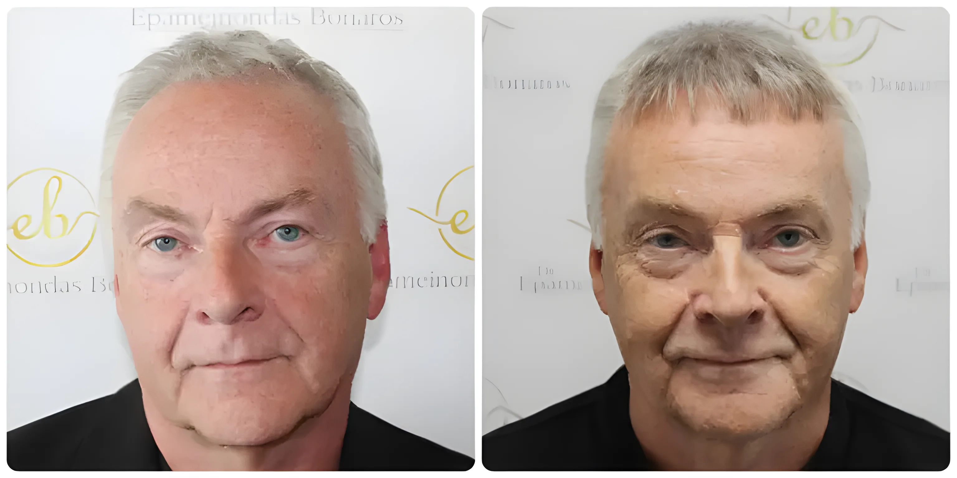 FUE full restoration, Norwood 6 — Dr Bonaros