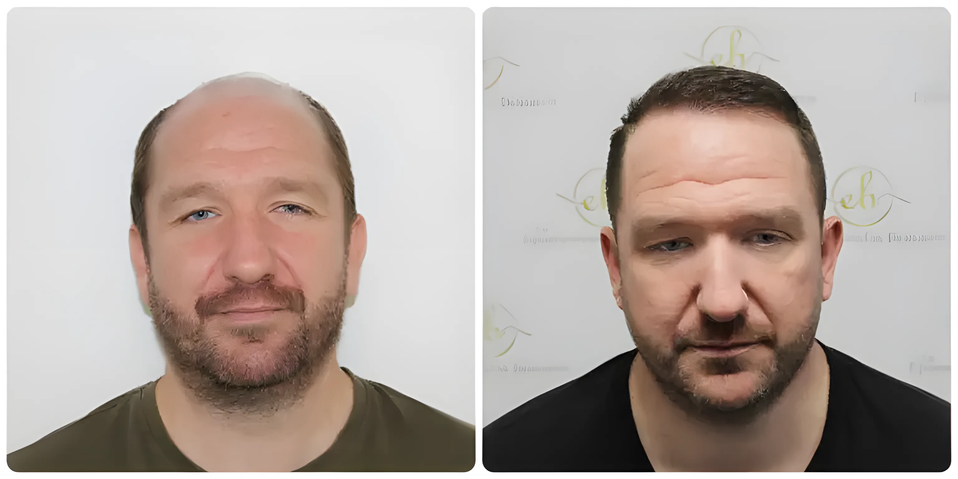 FUE hairline & crown restoration — Dr Bonaros