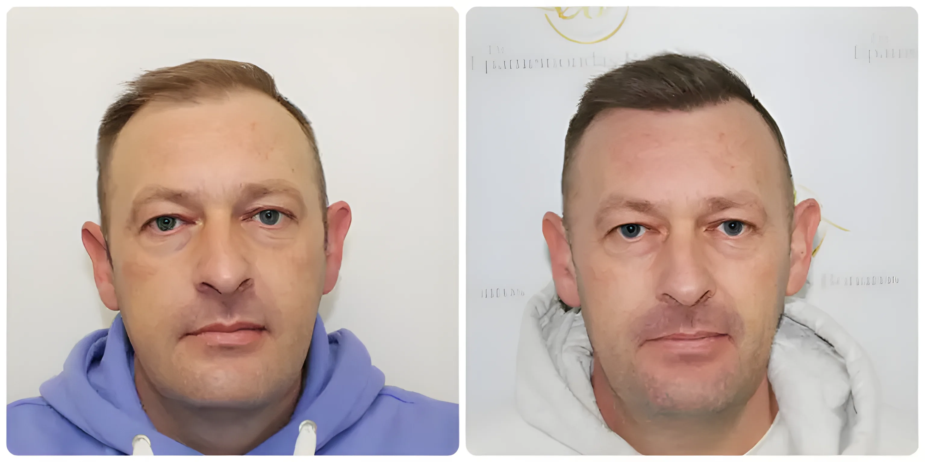 FUE hairline restoration — Dr Bonaros