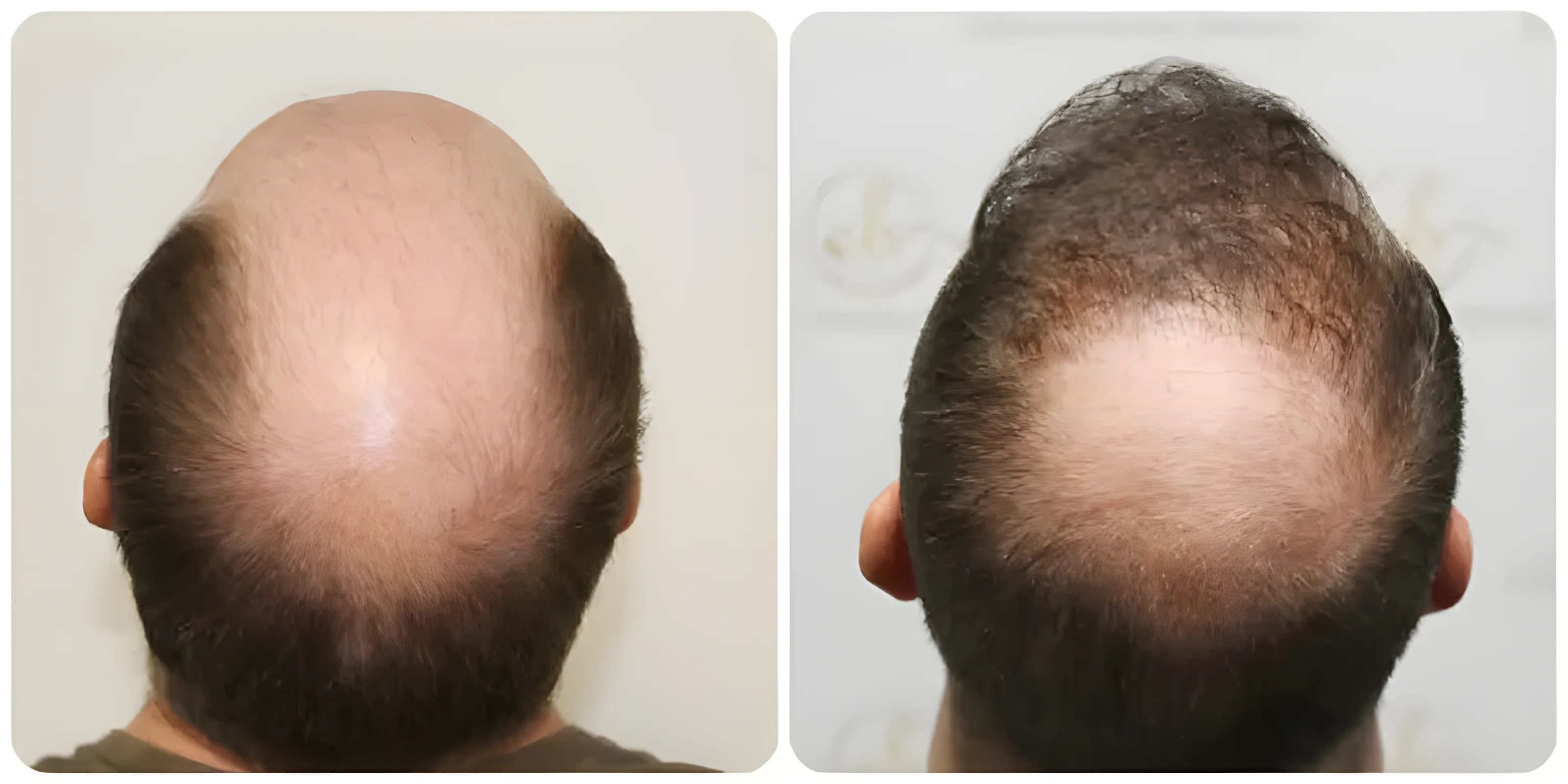 FUE crown coverage & density — Dr Bonaros