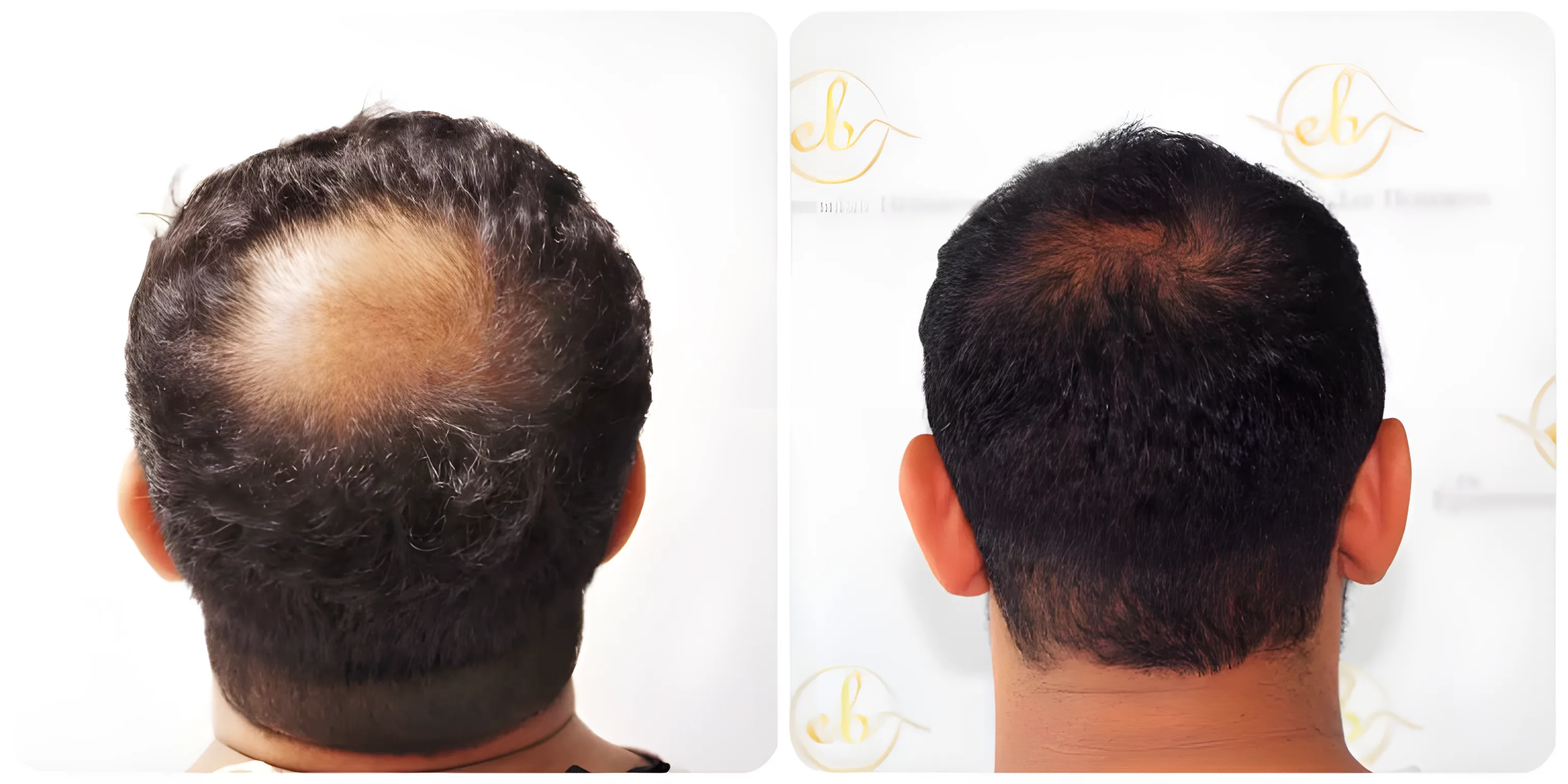 FUE crown transplant — 2,000 grafts