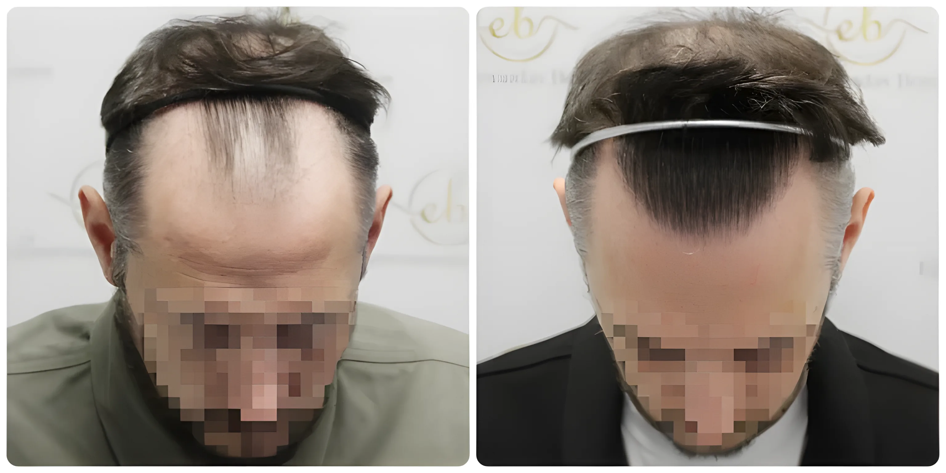 FUE hairline transplant — 2,122 grafts / 5,675 hairs
