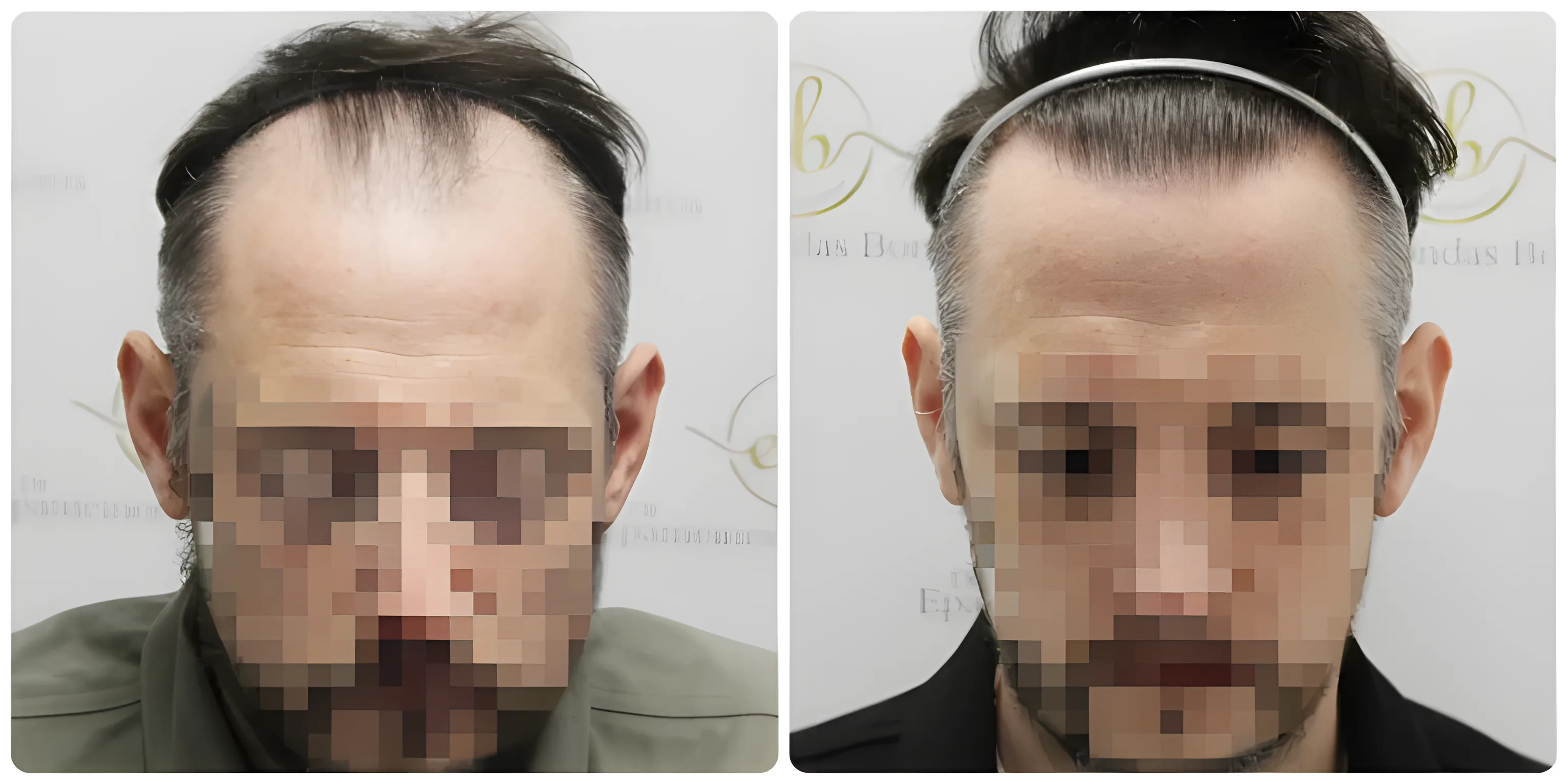 FUE hairline transplant — 2,122 grafts / 5,675 hairs