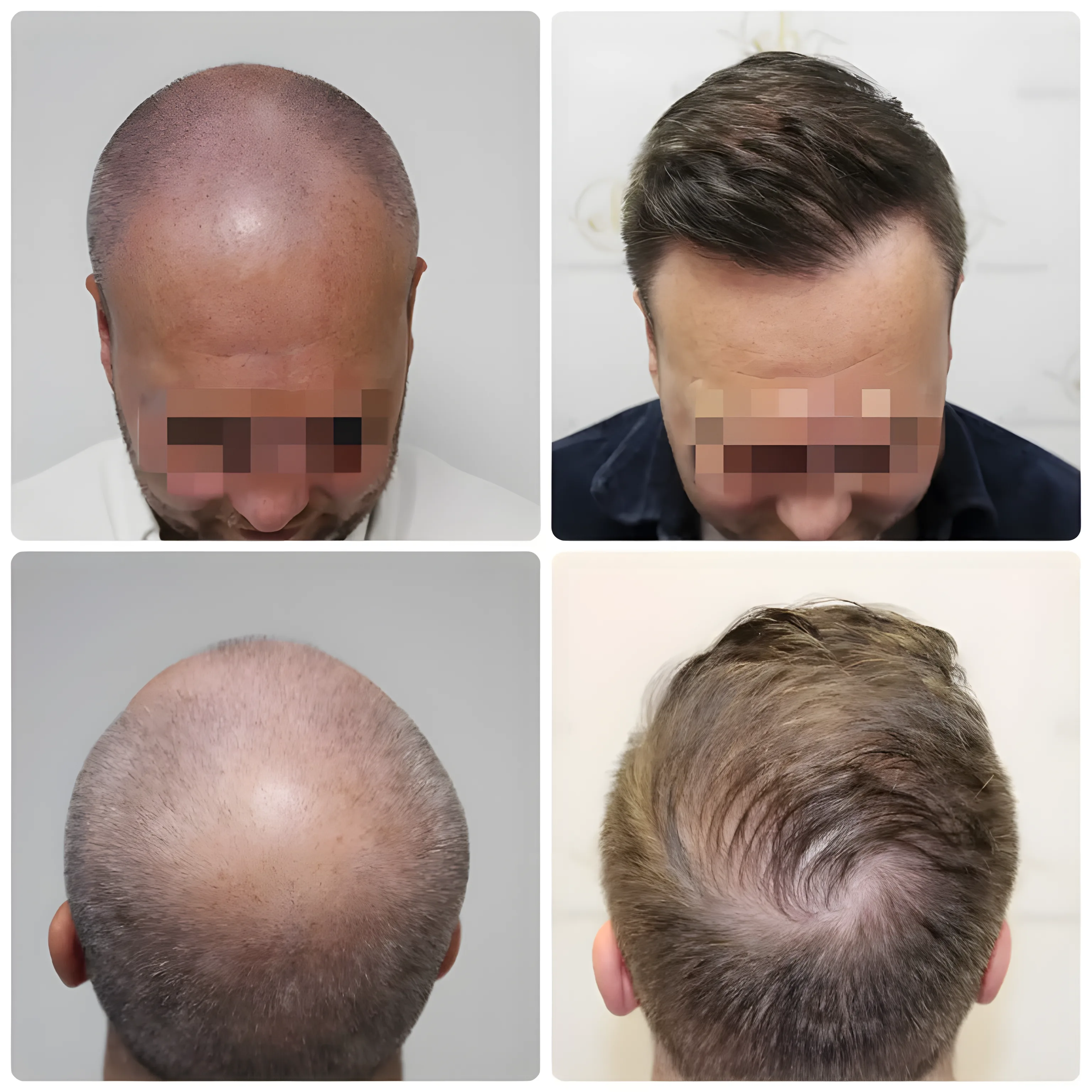 FUE receding hairline & crown — 4,076 grafts / 7,573 hairs