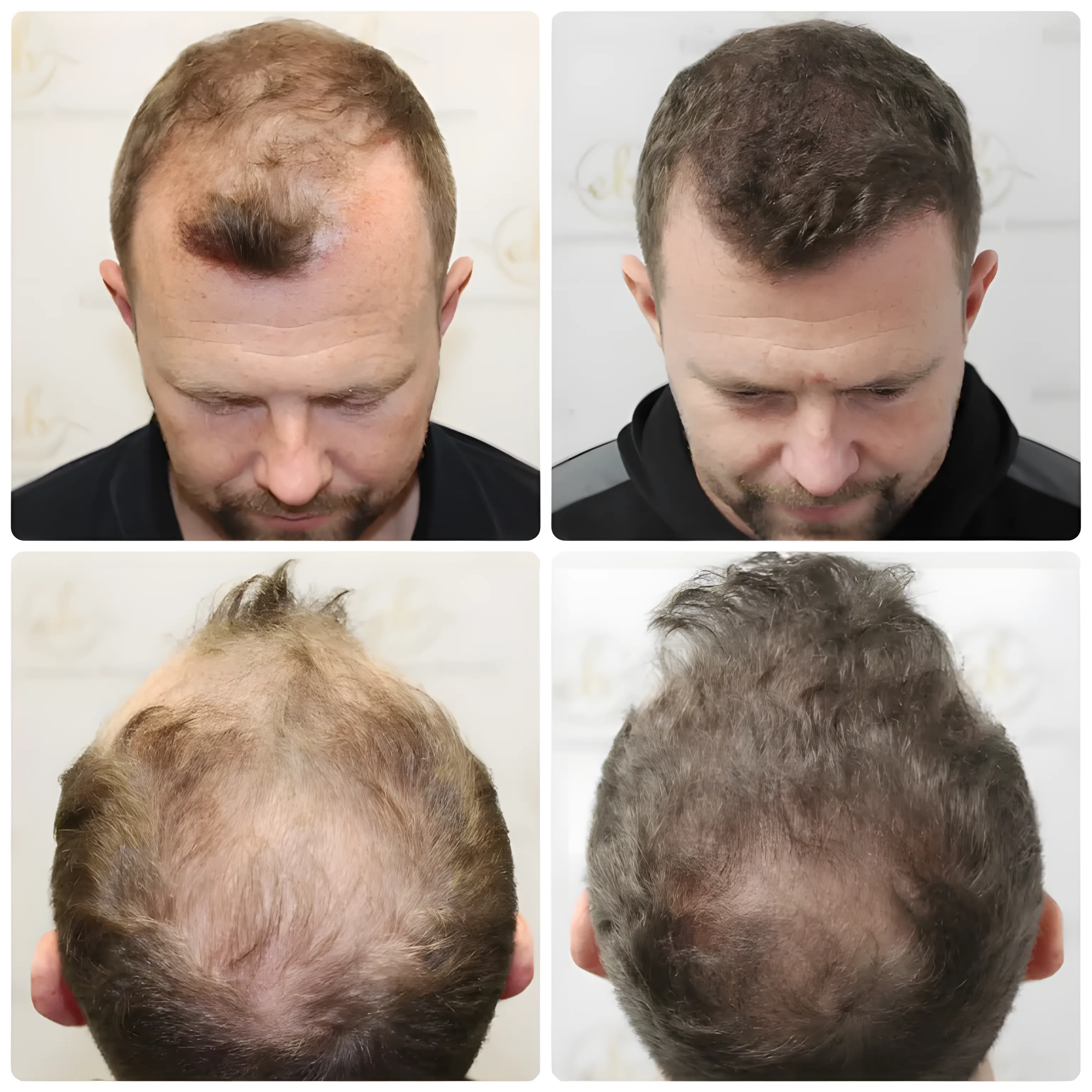 FUE hairline & mid-scalp — 4,049 grafts / 12,260 hairs