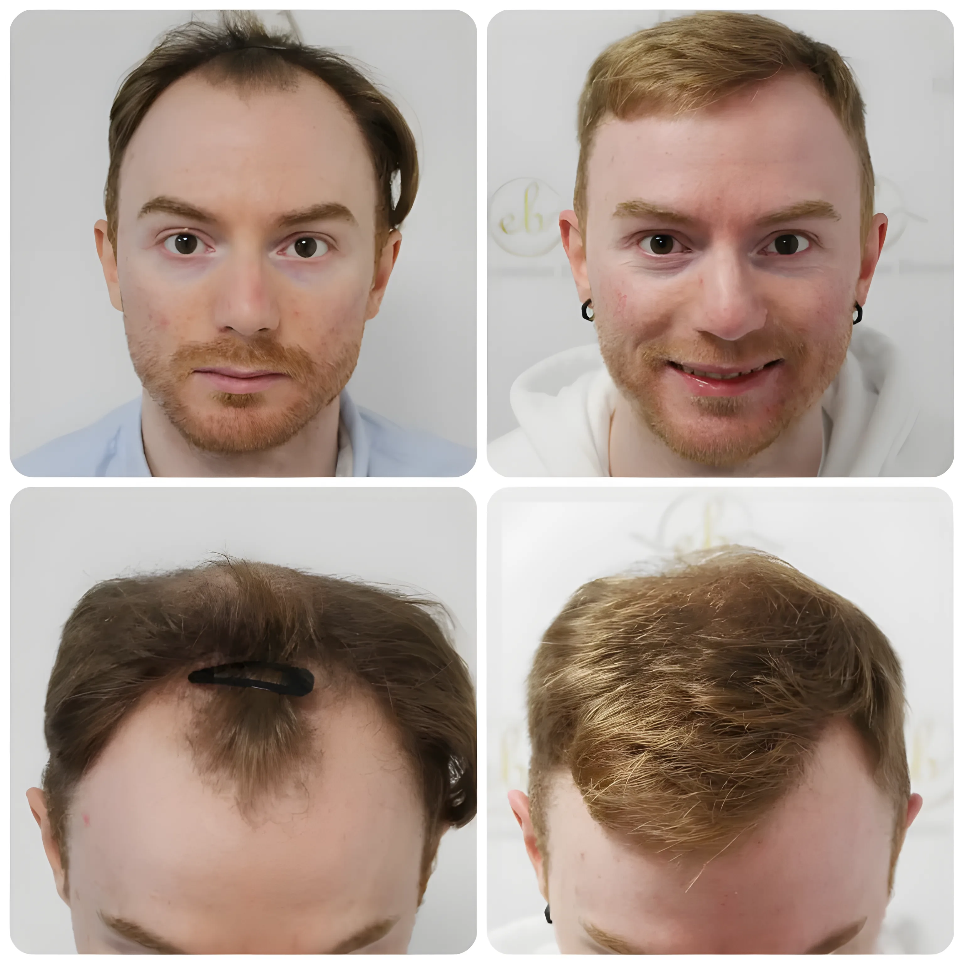 FUE hairline & crown — 3,641 grafts / 7,640 hairs