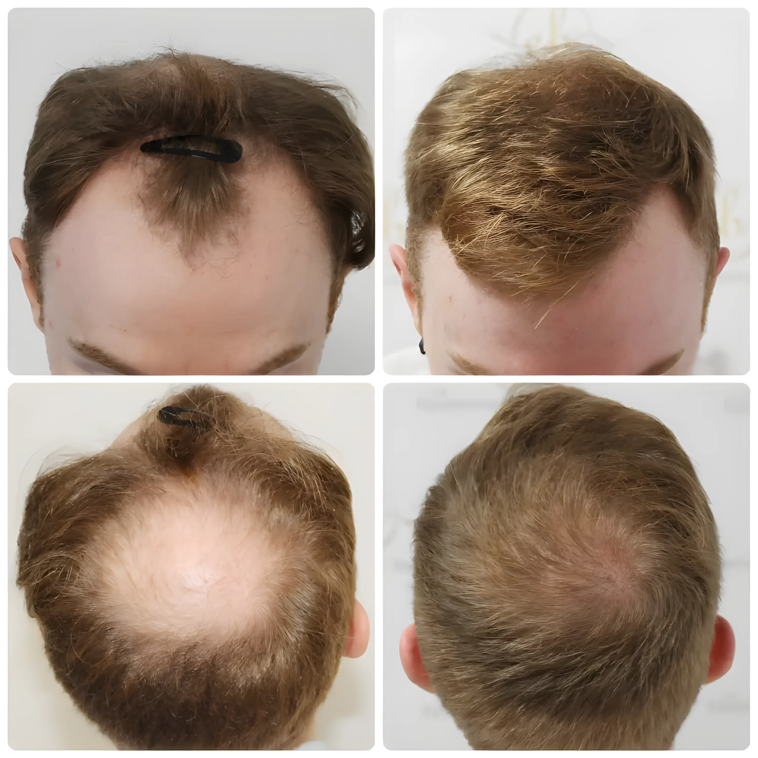 FUE hairline & crown — 3,641 grafts / 7,640 hairs