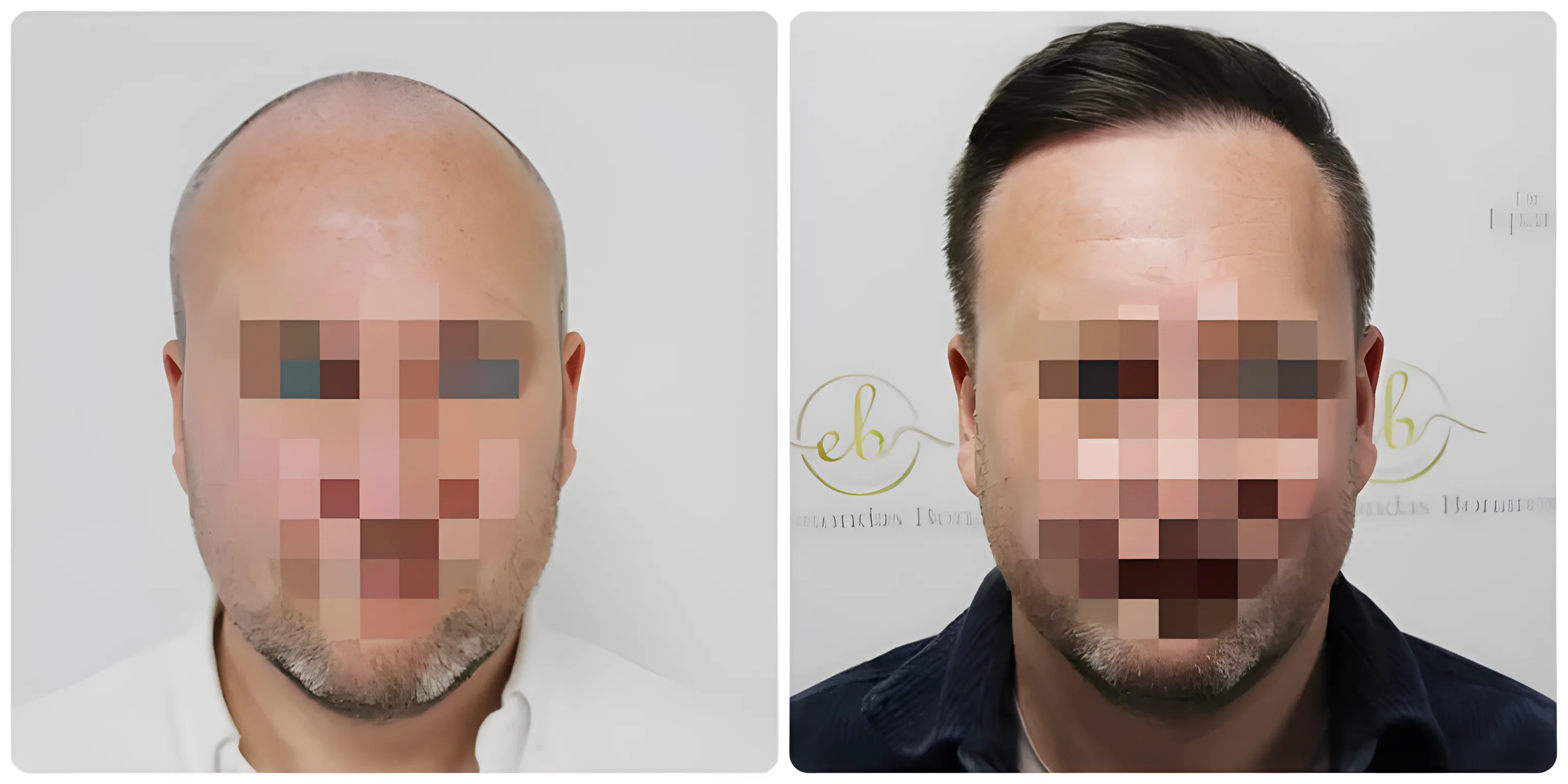 FUE receding hairline & crown — 4,076 grafts / 7,573 hairs
