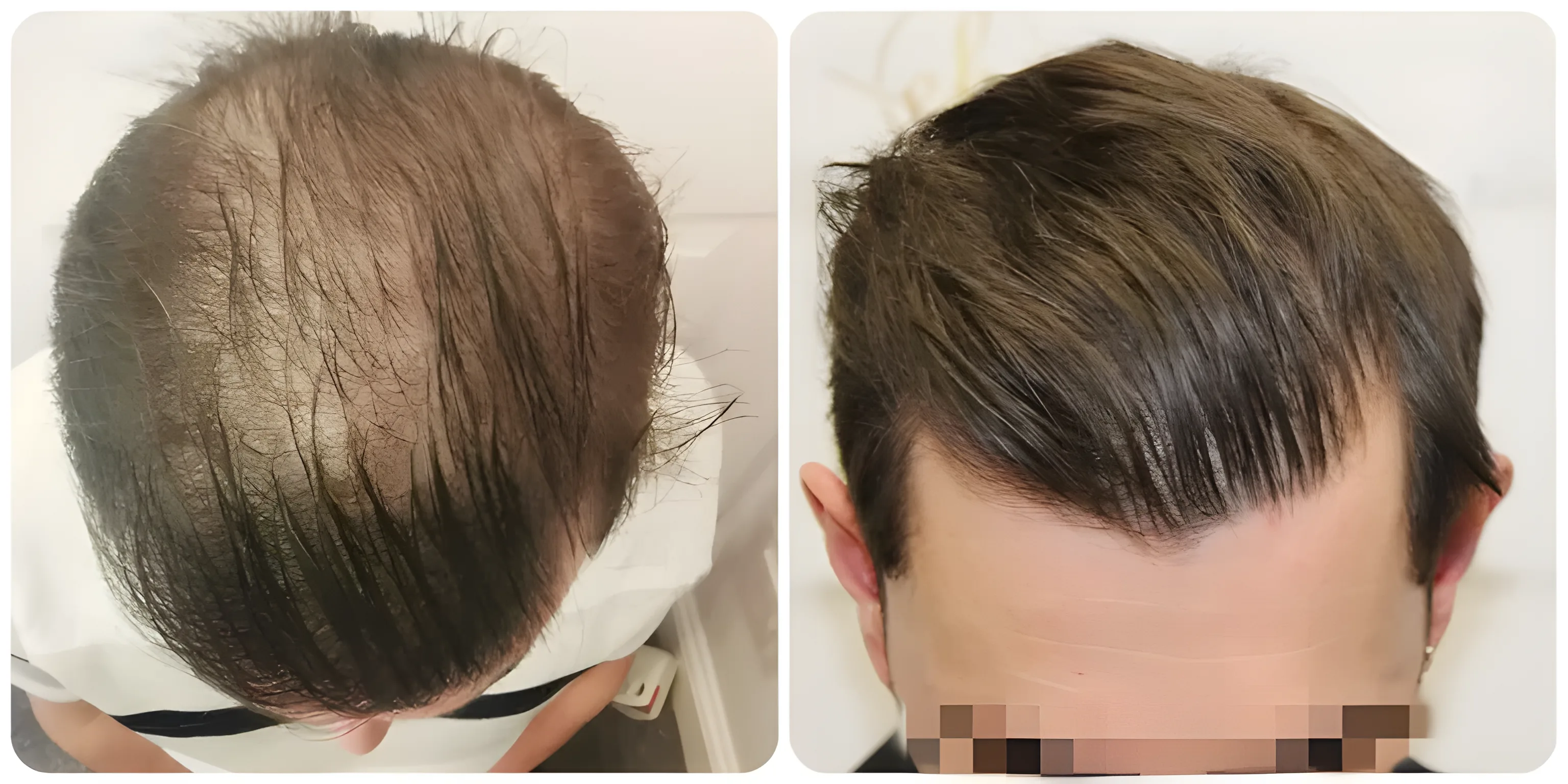 FUE mid-scalp transplant — 1,979 grafts / 4,272 hairs