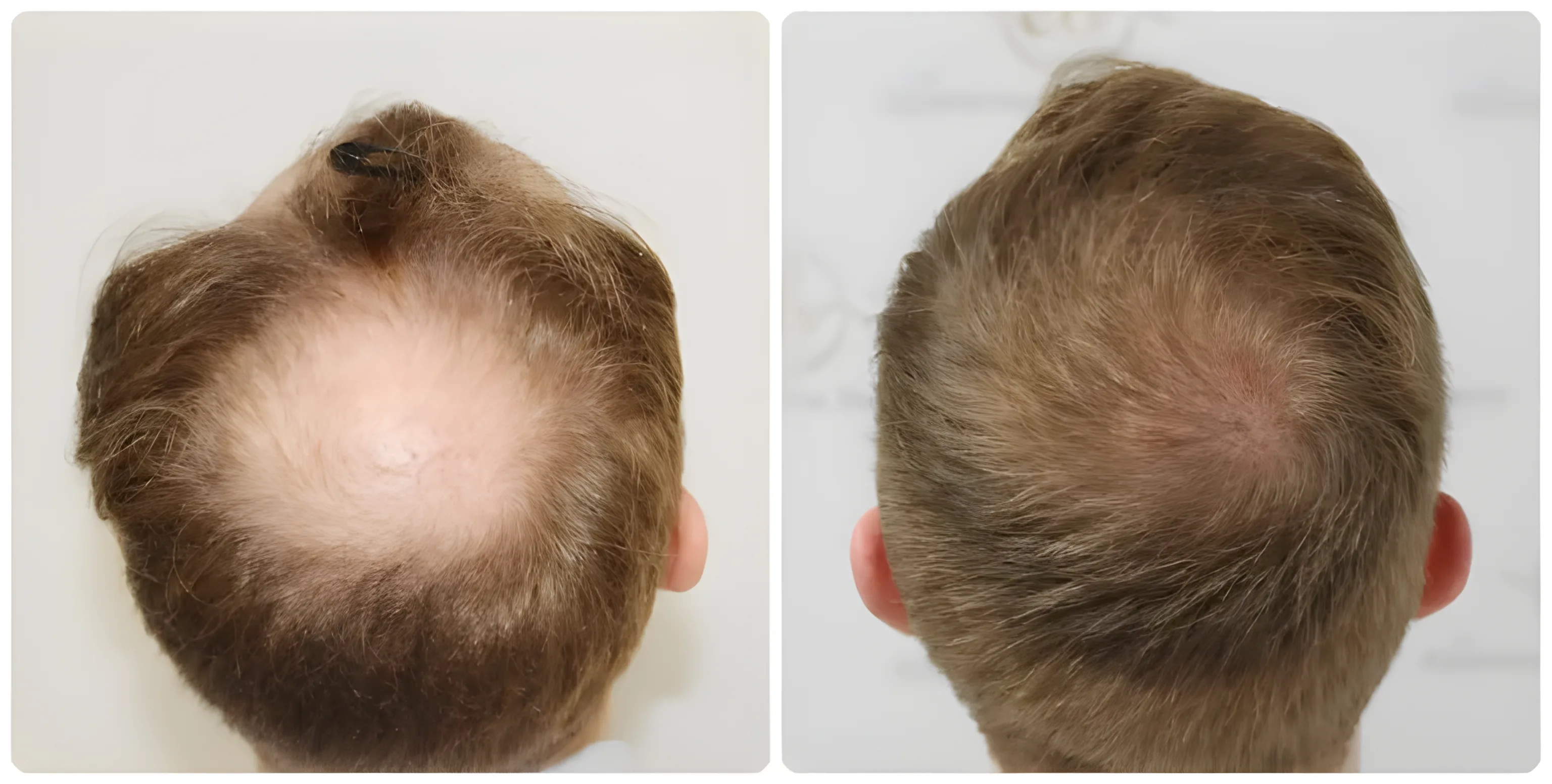 FUE hairline & crown — 3,641 grafts / 7,640 hairs
