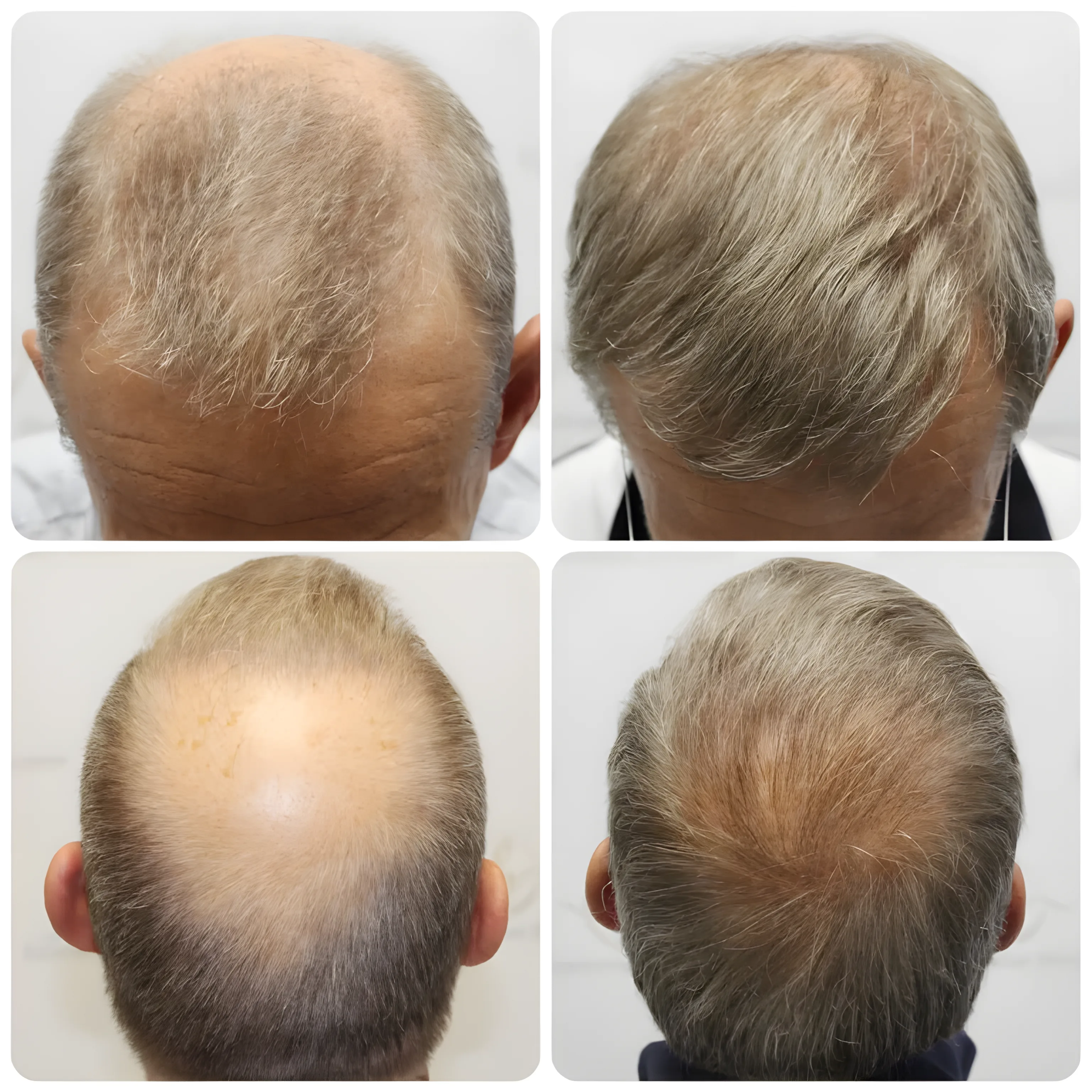 FUE hairline, crown & lateral humps — 3,102 grafts / 5,635 hairs