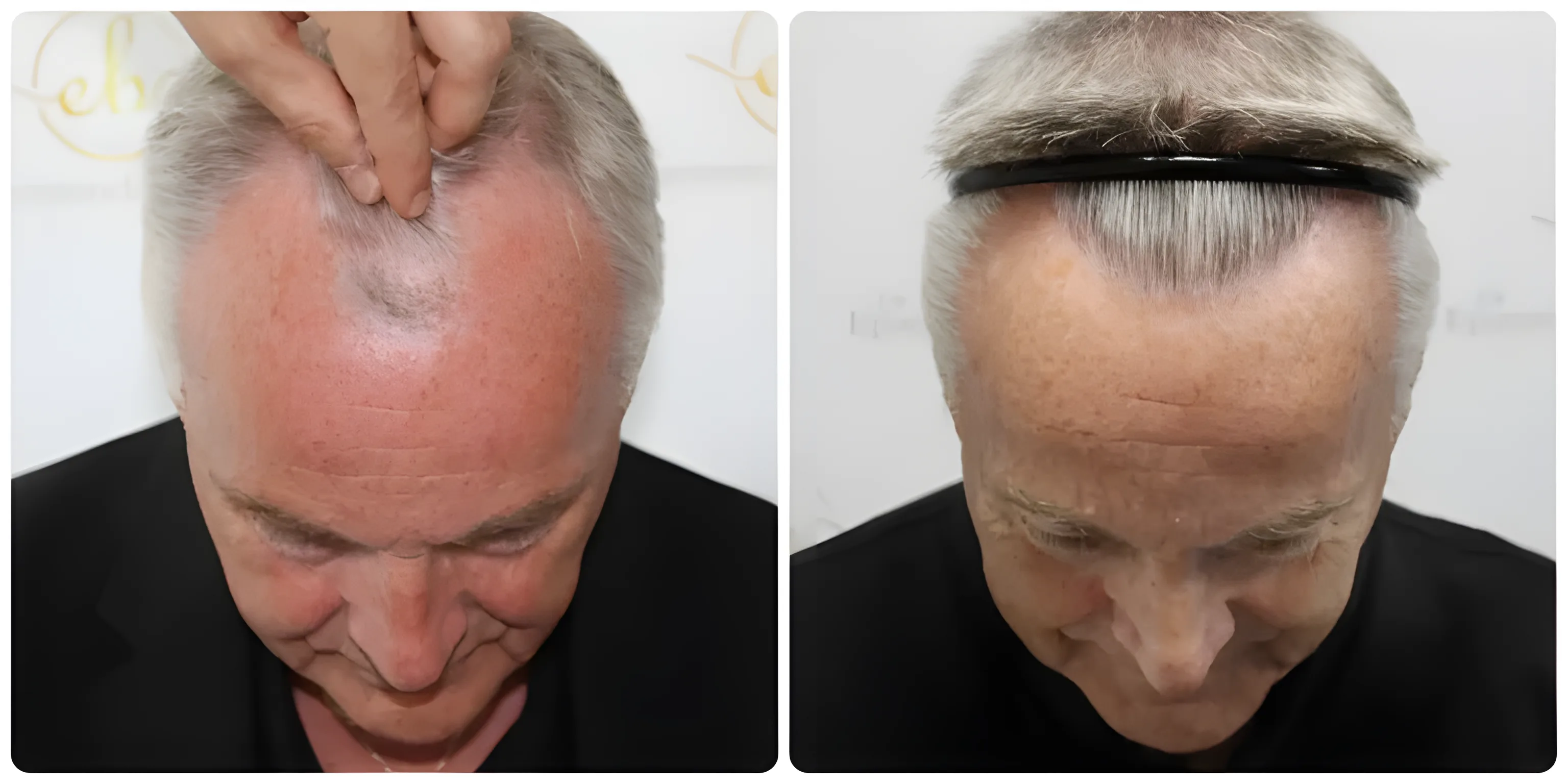 FUE hairline & crown — 3,413 grafts / 7,515 hairs