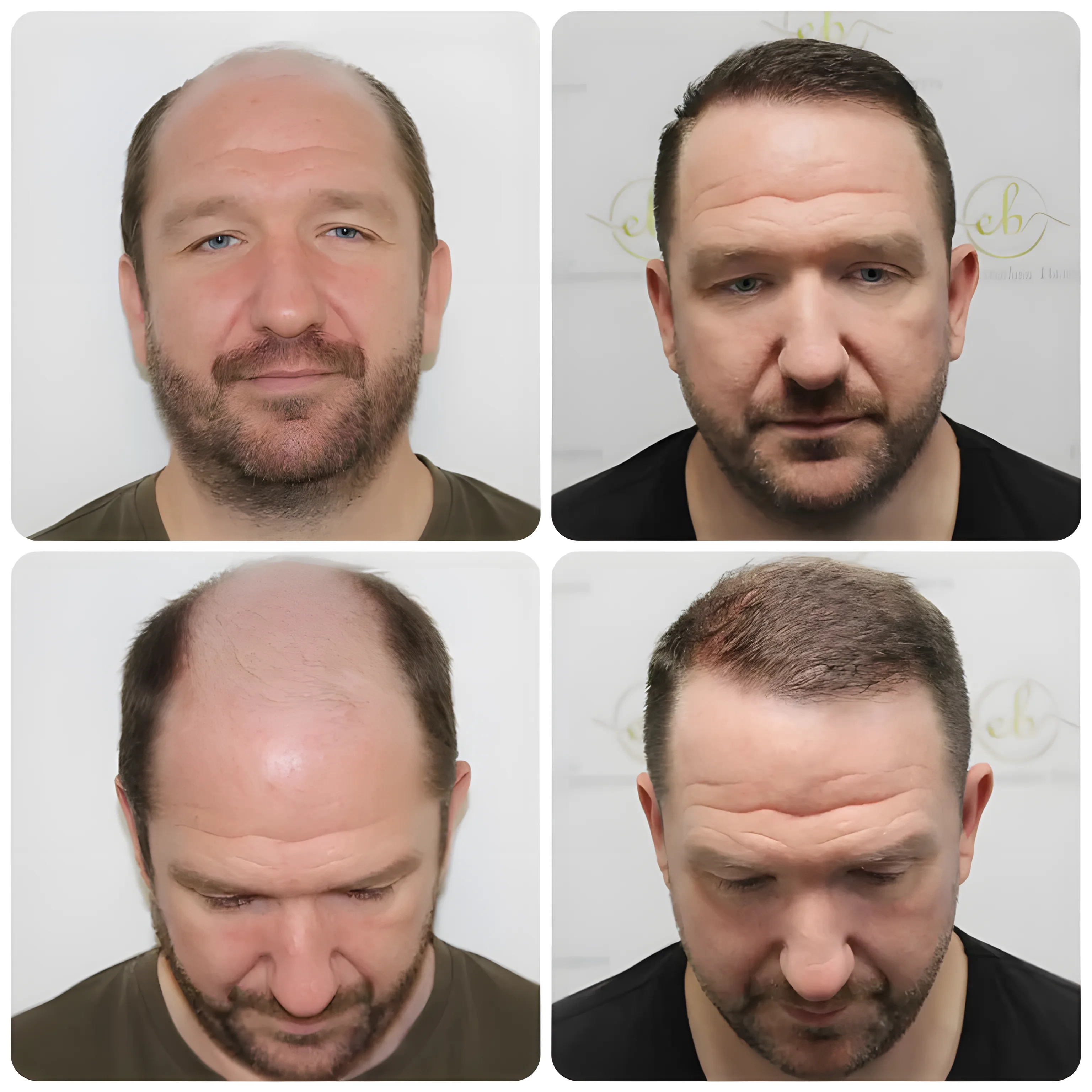 FUE hairline & mid-scalp — 3,796 grafts / 8,241 hairs