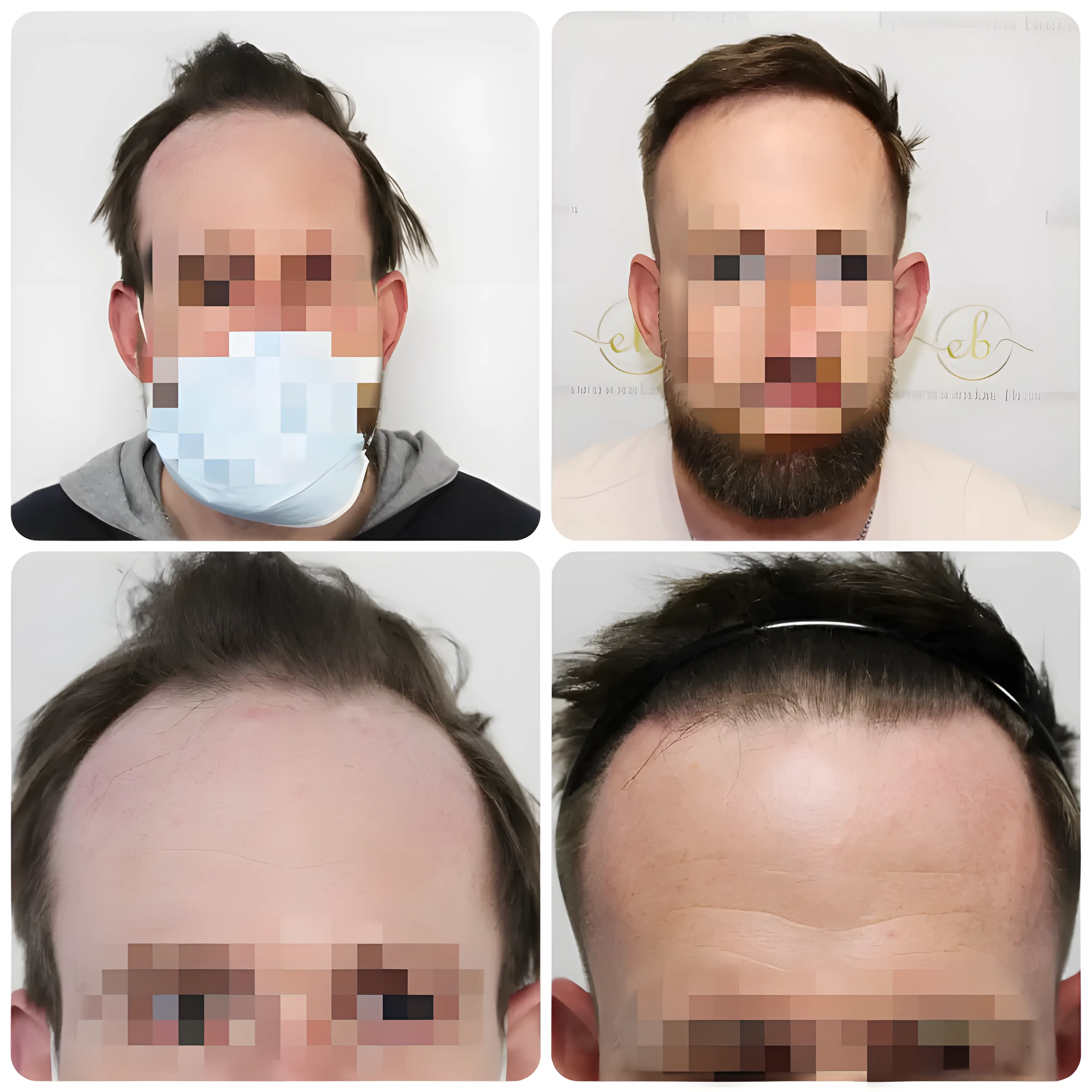 FUE hairline transplant — 1,854 grafts / 3,763 hairs