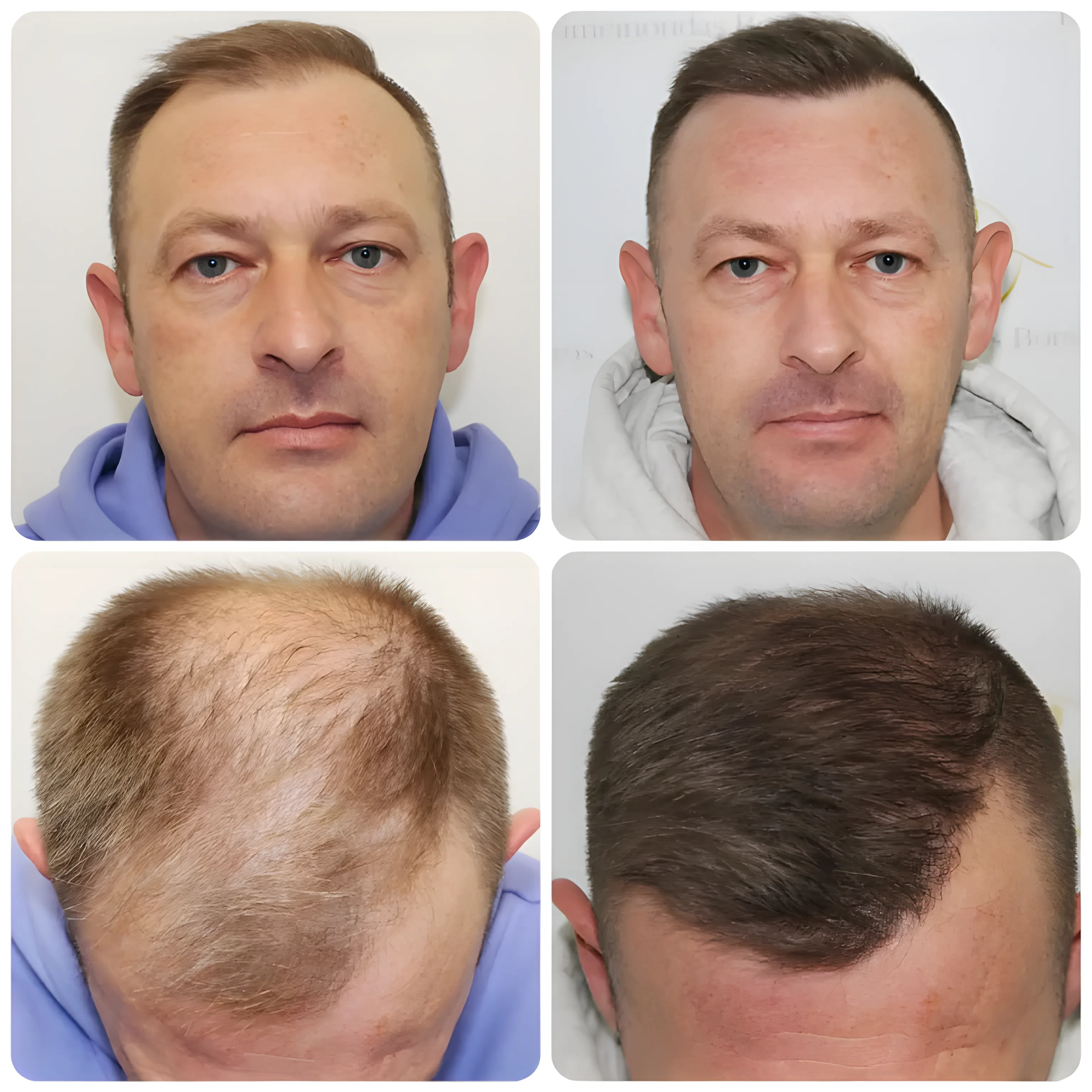 FUE receding hairline — 1,814 grafts / 4,752 hairs