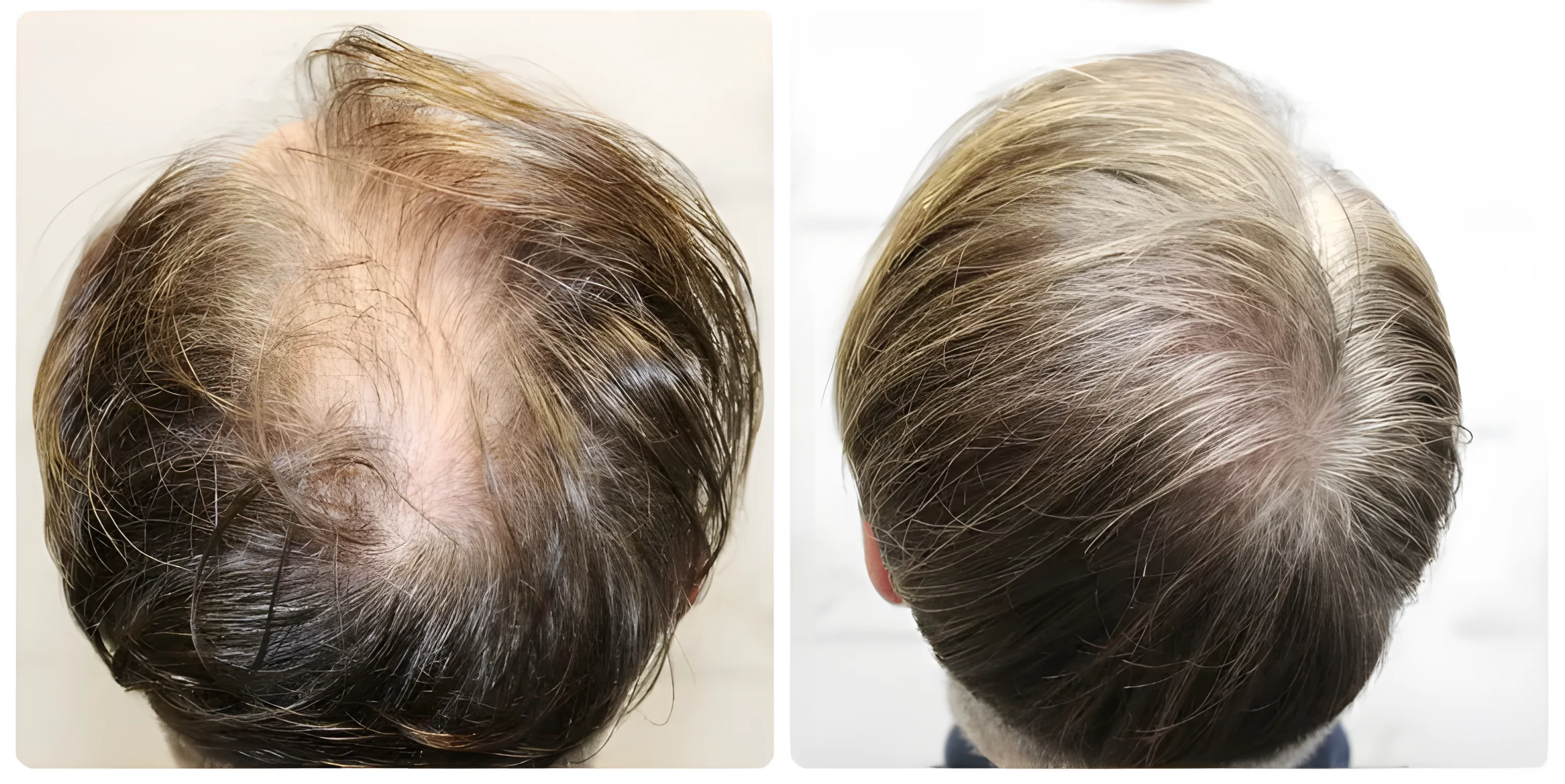 FUE hairline & crown — 3,207 grafts / 6,763 hairs
