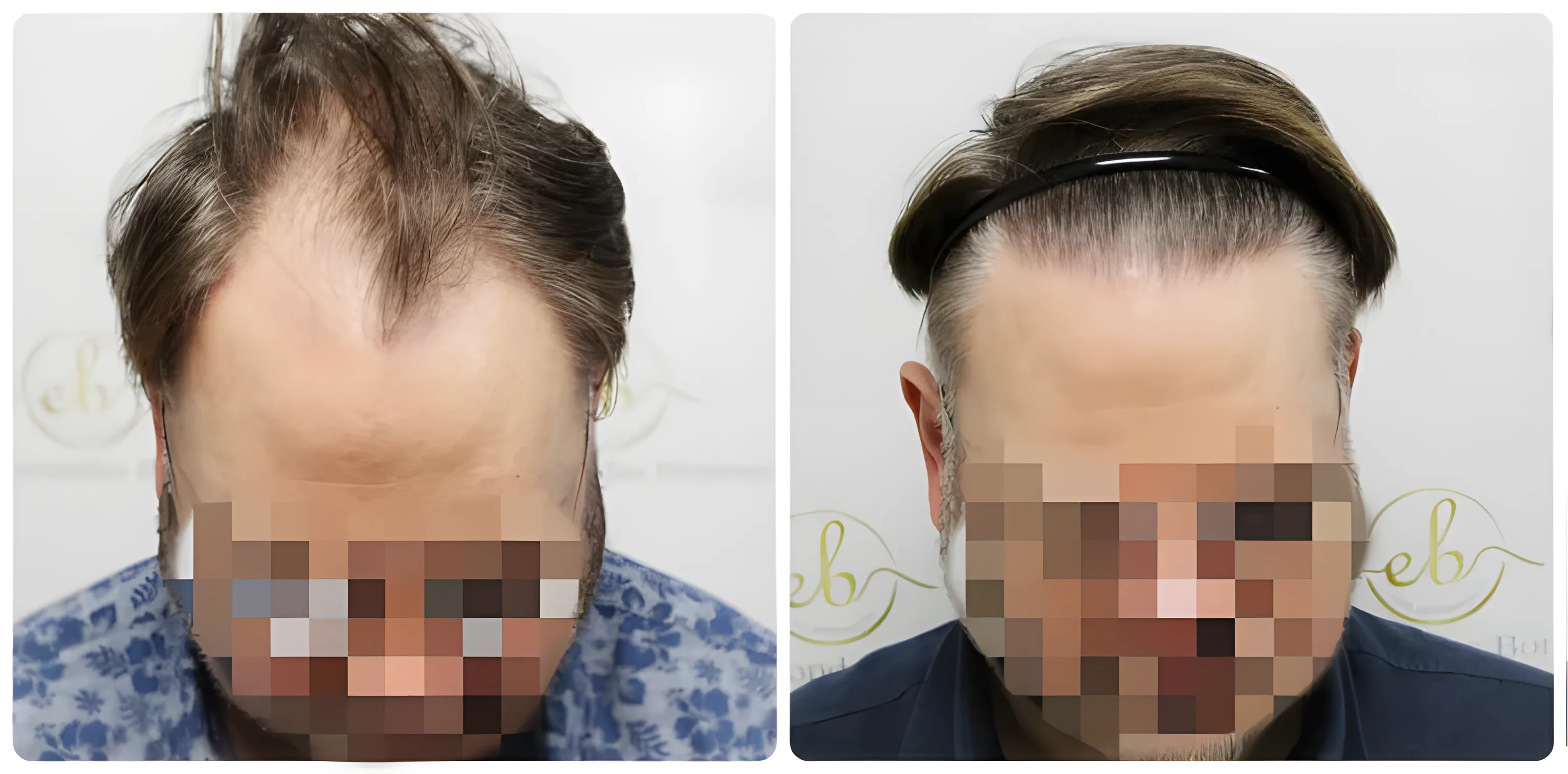 FUE hairline & crown — 3,207 grafts / 6,763 hairs