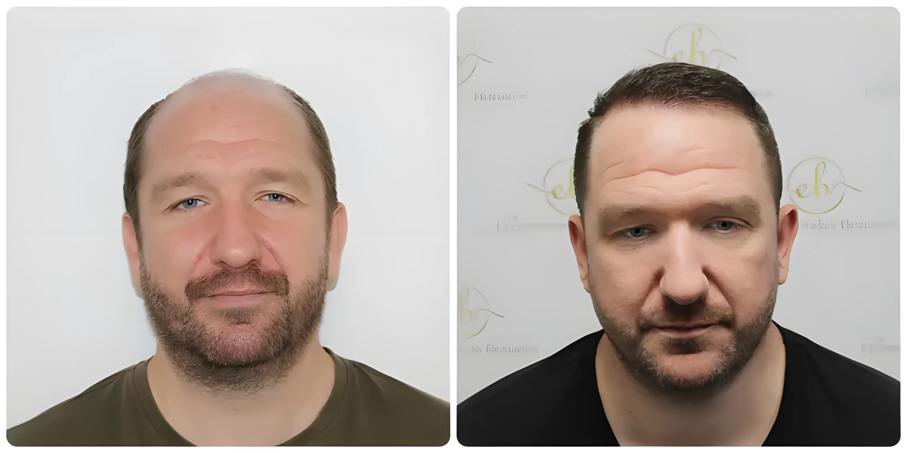 FUE hairline & mid-scalp — 3,796 grafts / 8,241 hairs