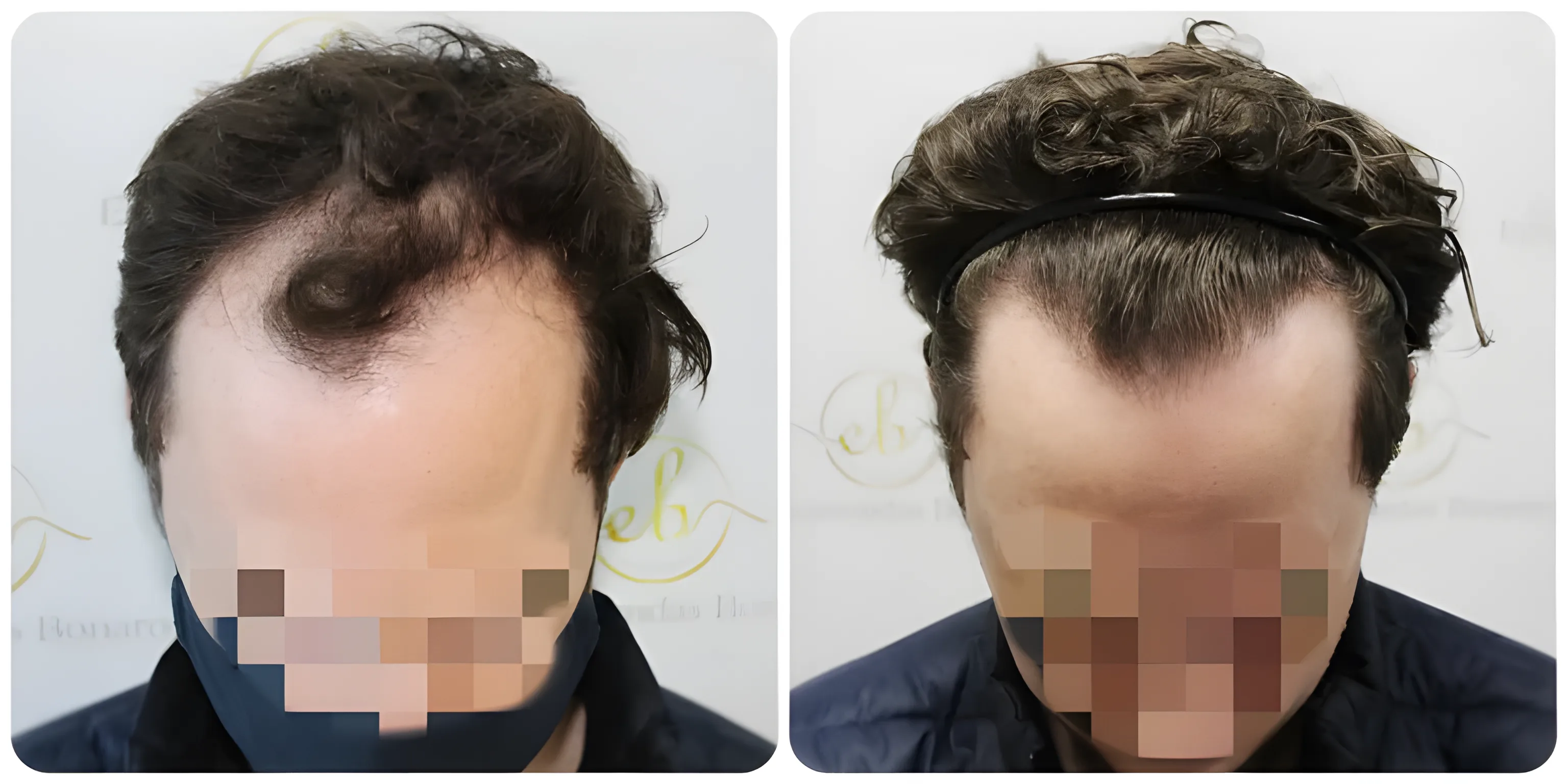 FUE receding hairline — 2,003 grafts / 3,939 hairs