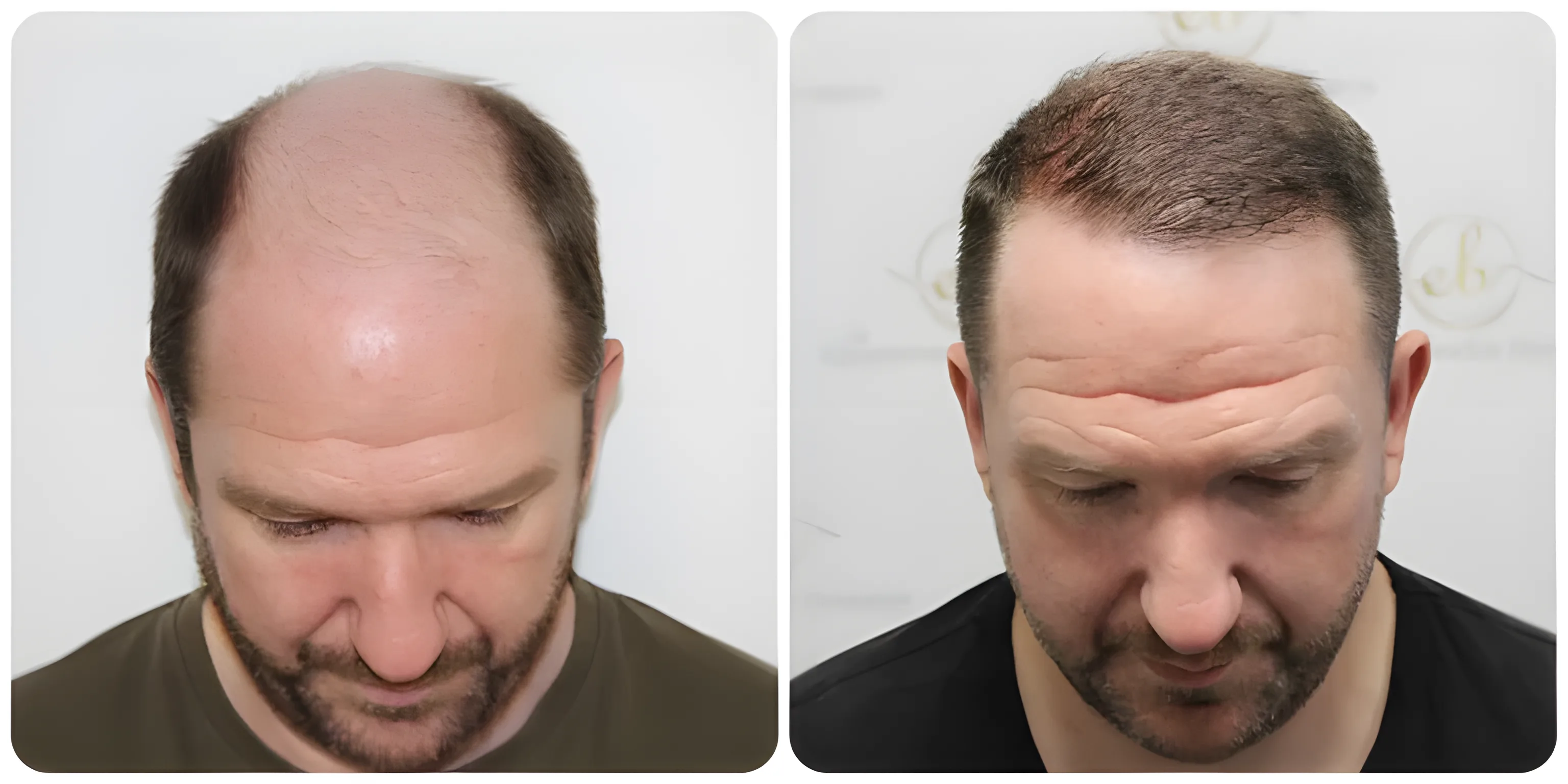 FUE hairline & mid-scalp — 3,796 grafts / 8,241 hairs