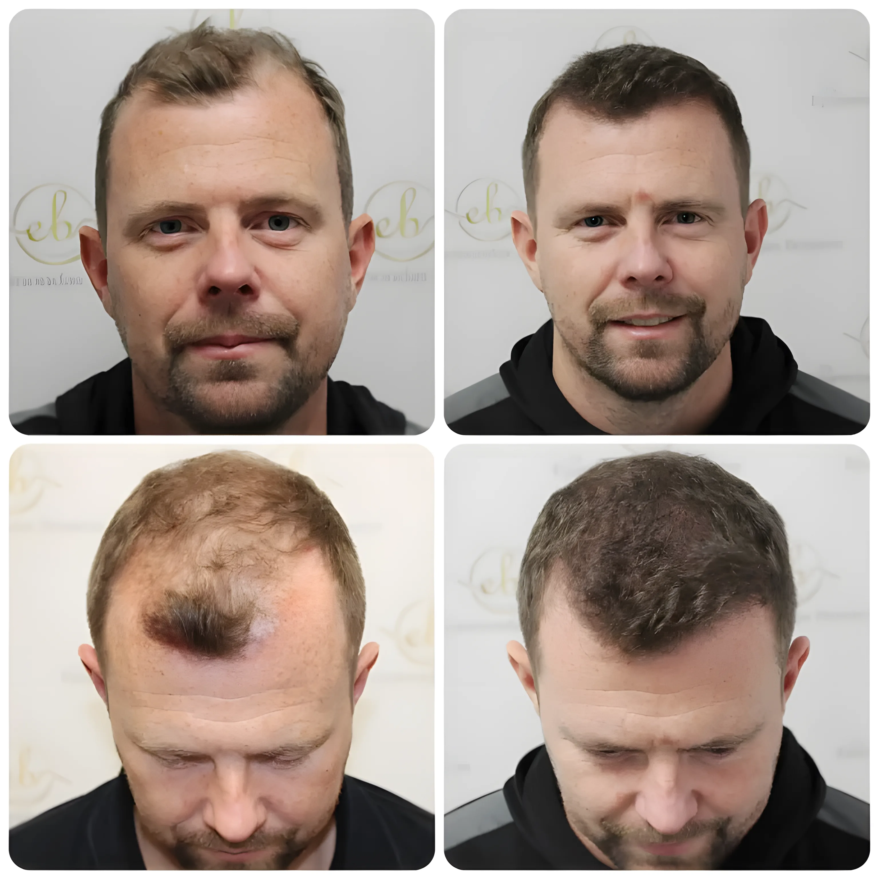 FUE hairline & mid-scalp — 4,049 grafts / 12,260 hairs