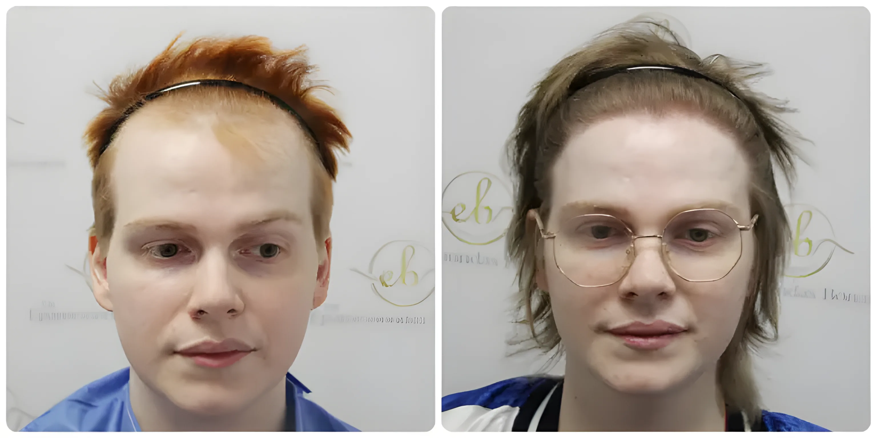 FUE frontal & crown restoration — Dr Bonaros