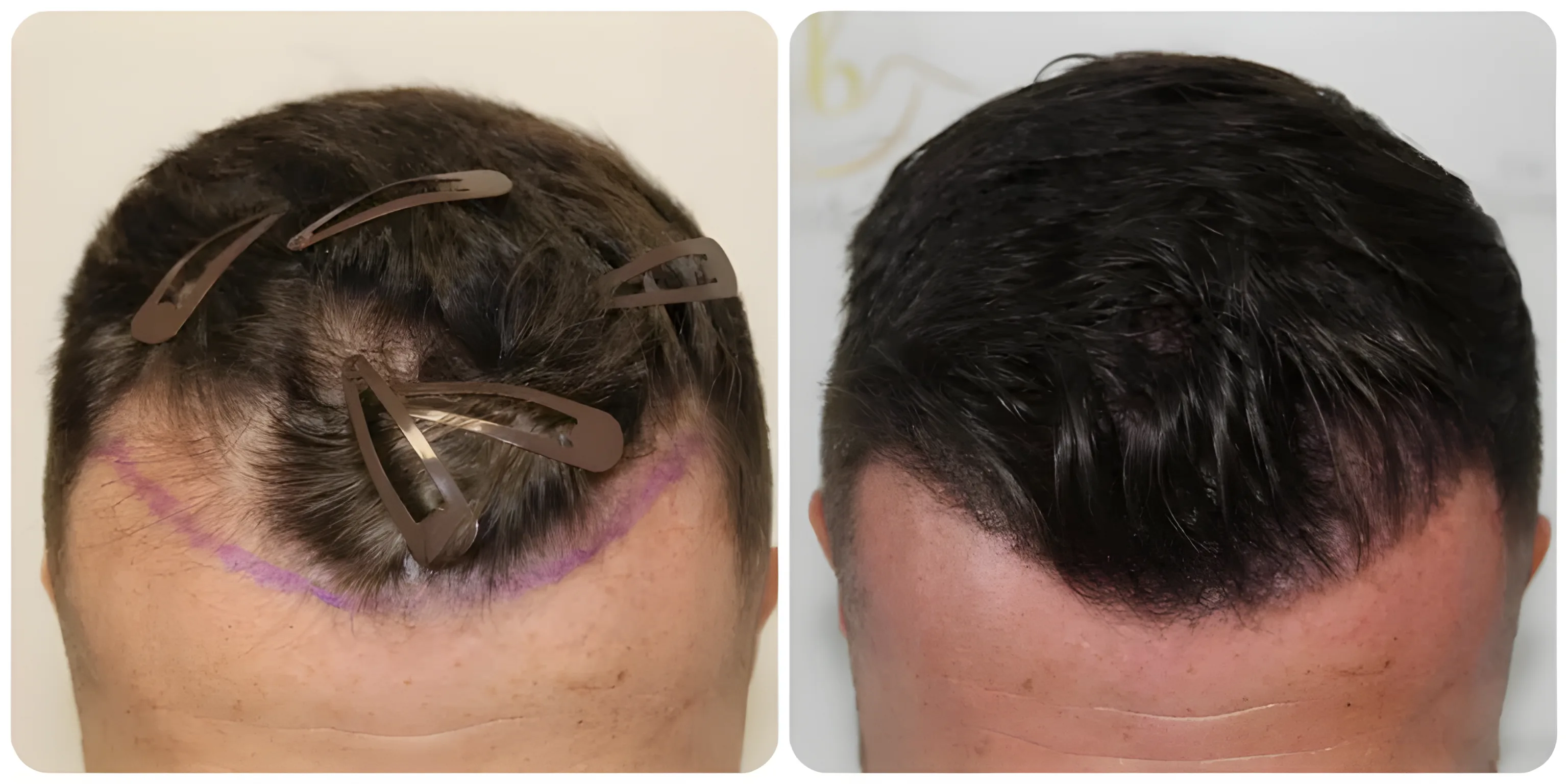 FUE receding hairline — 1,456 grafts / 3,621 hairs