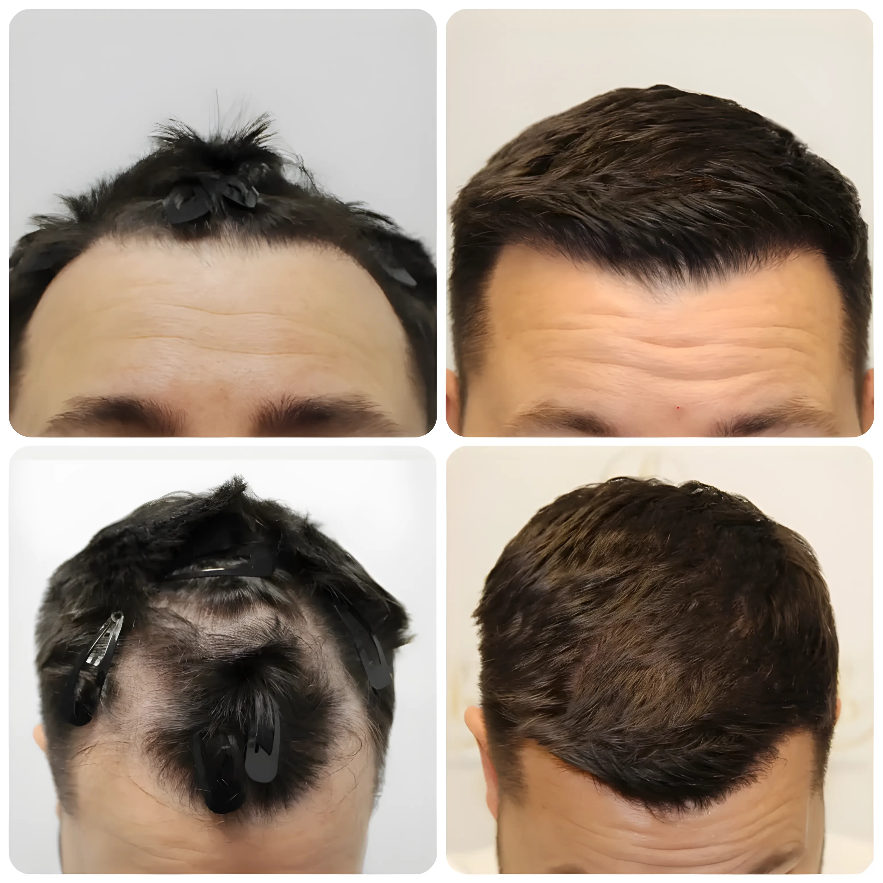 FUE hairline transplant — 1,500 grafts (temples)