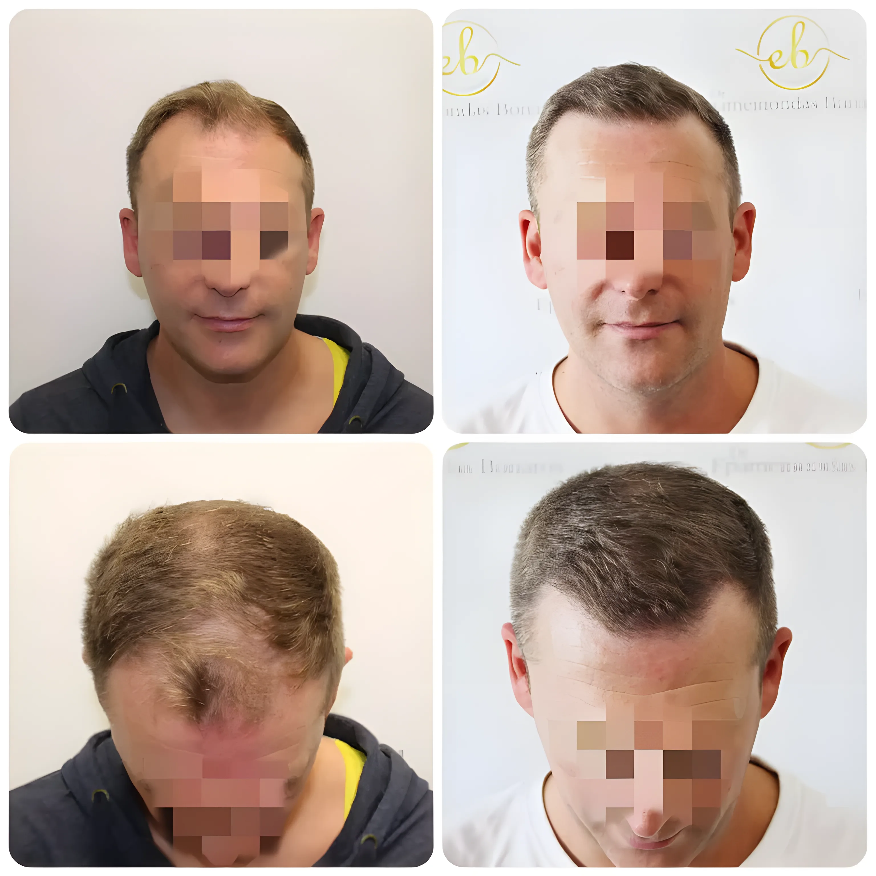 FUE hairline transplant — 1,841 grafts