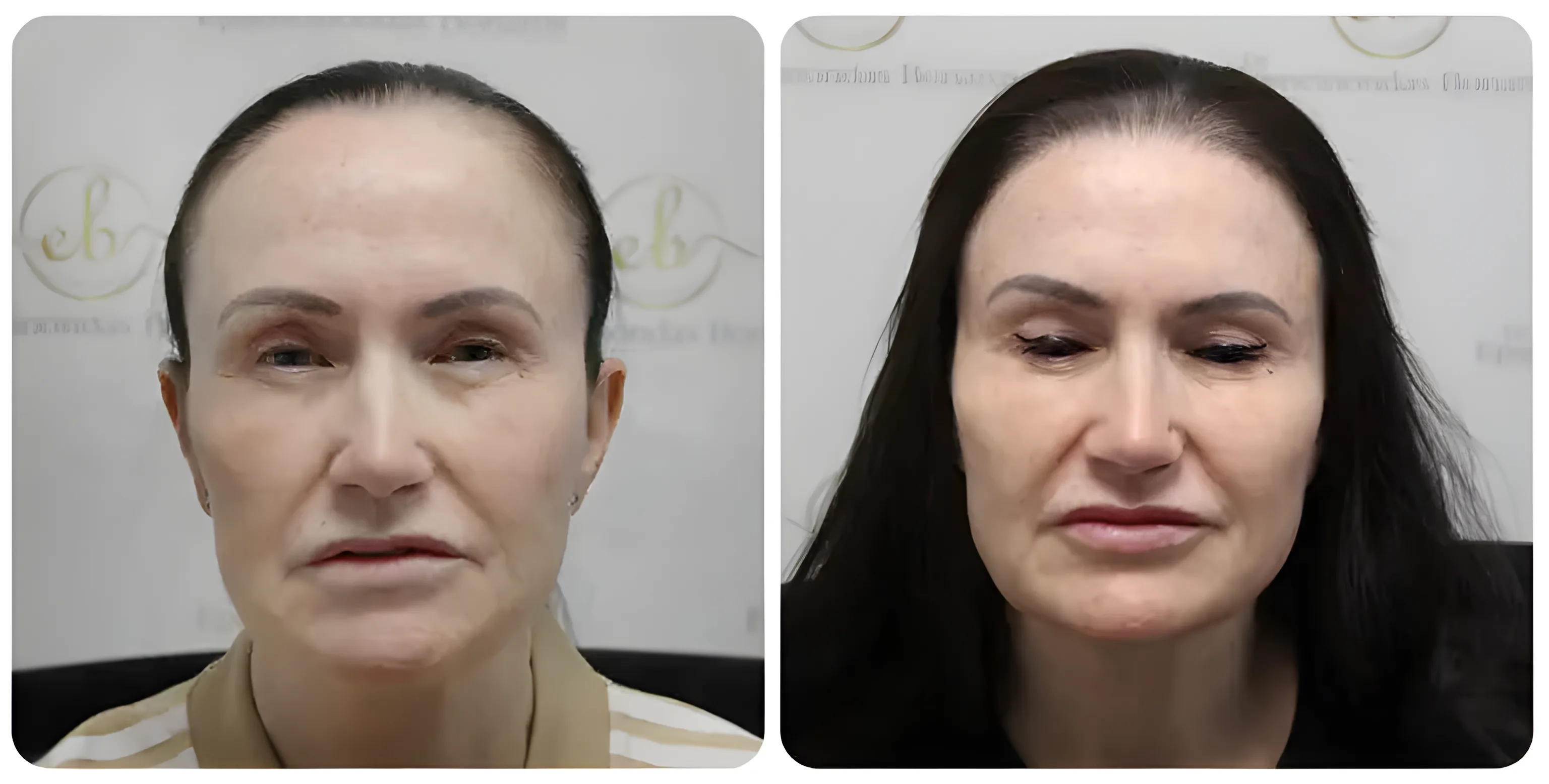 FUE hairline restoration — Dr Bonaros