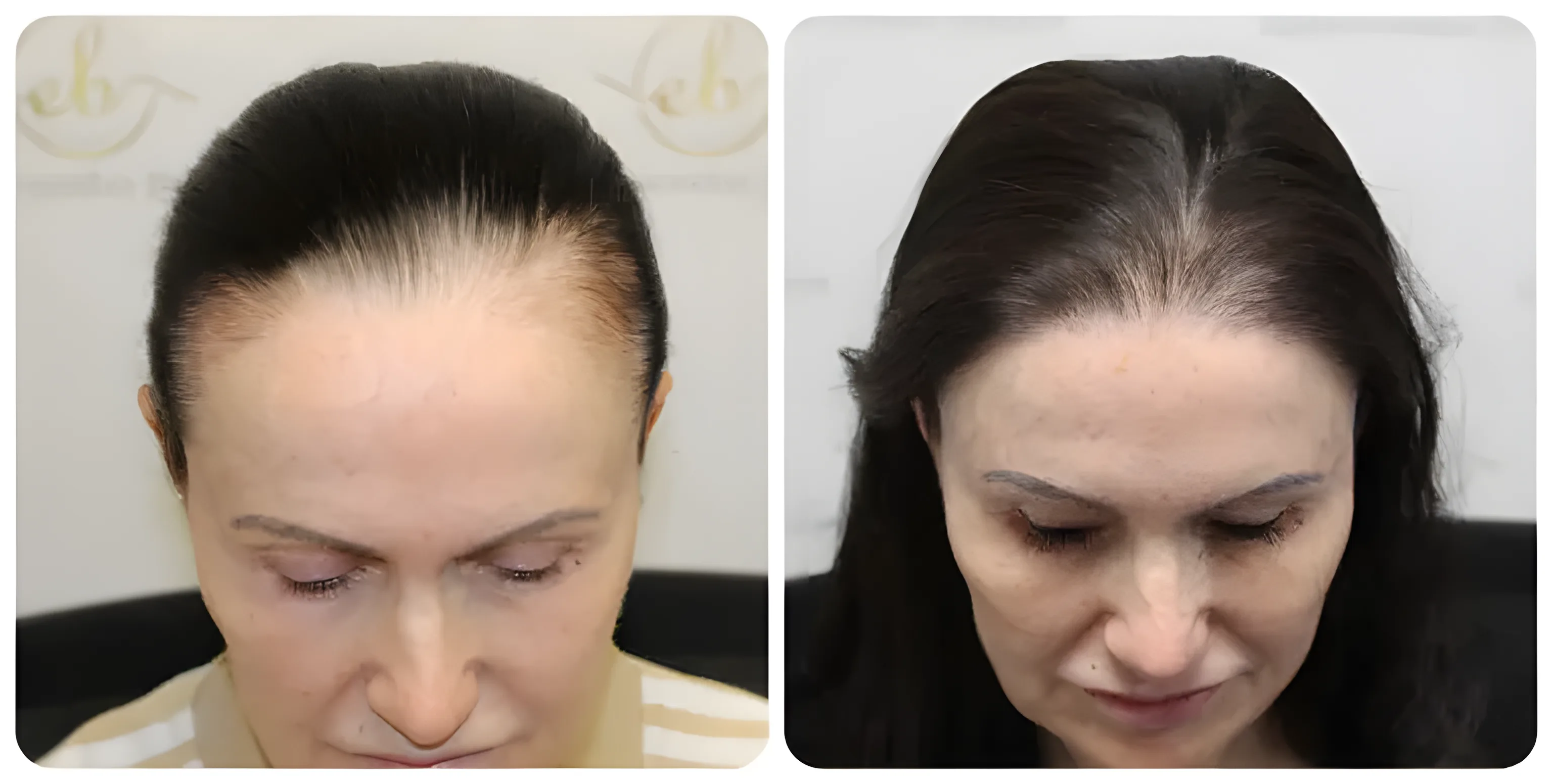 FUE hairline restoration — Dr Bonaros