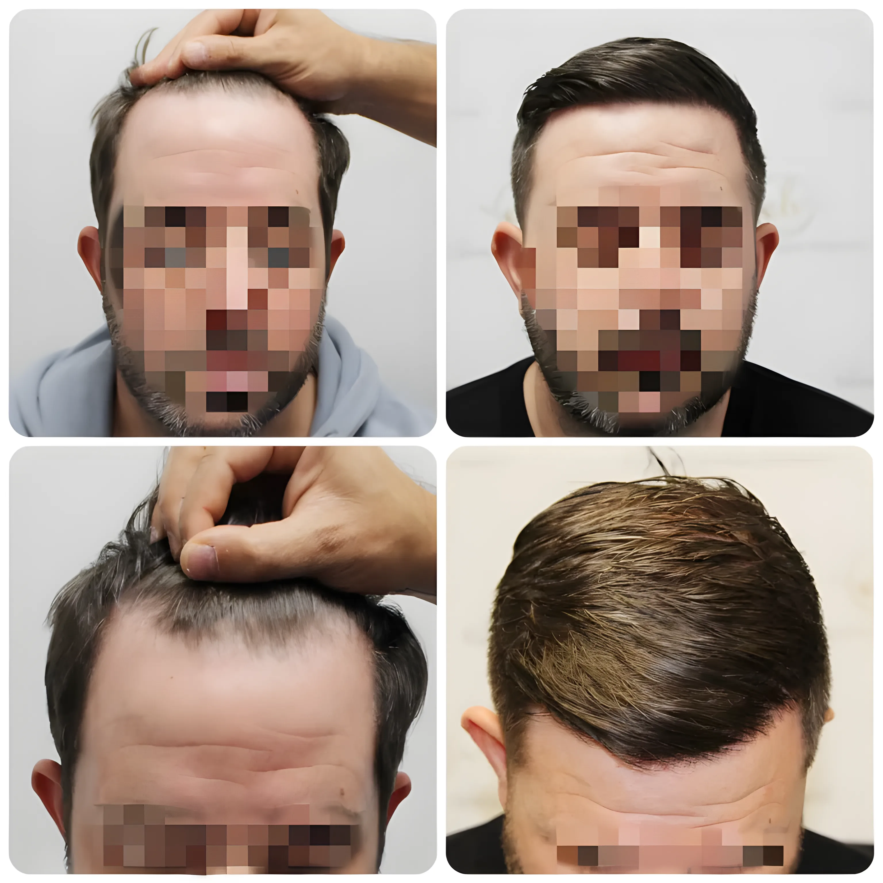 FUE hairline transplant — 1,446 grafts / 3,197 hairs