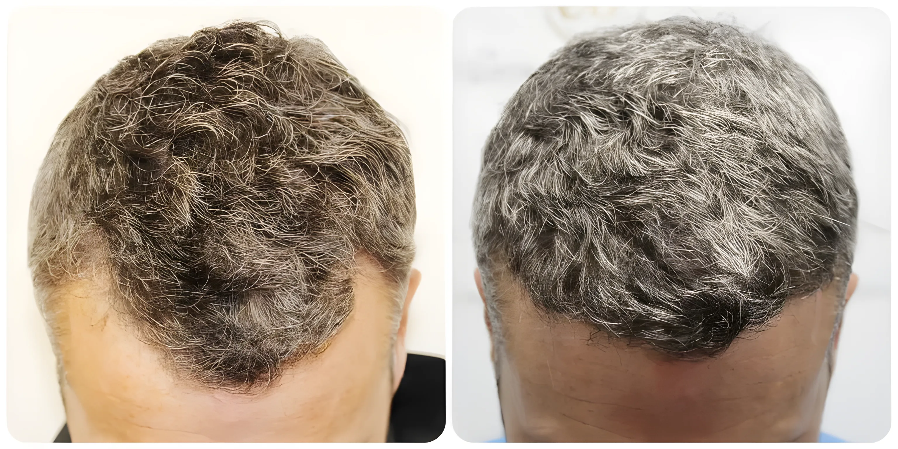FUE receding hairline — 1,522 grafts / 3,366 hairs