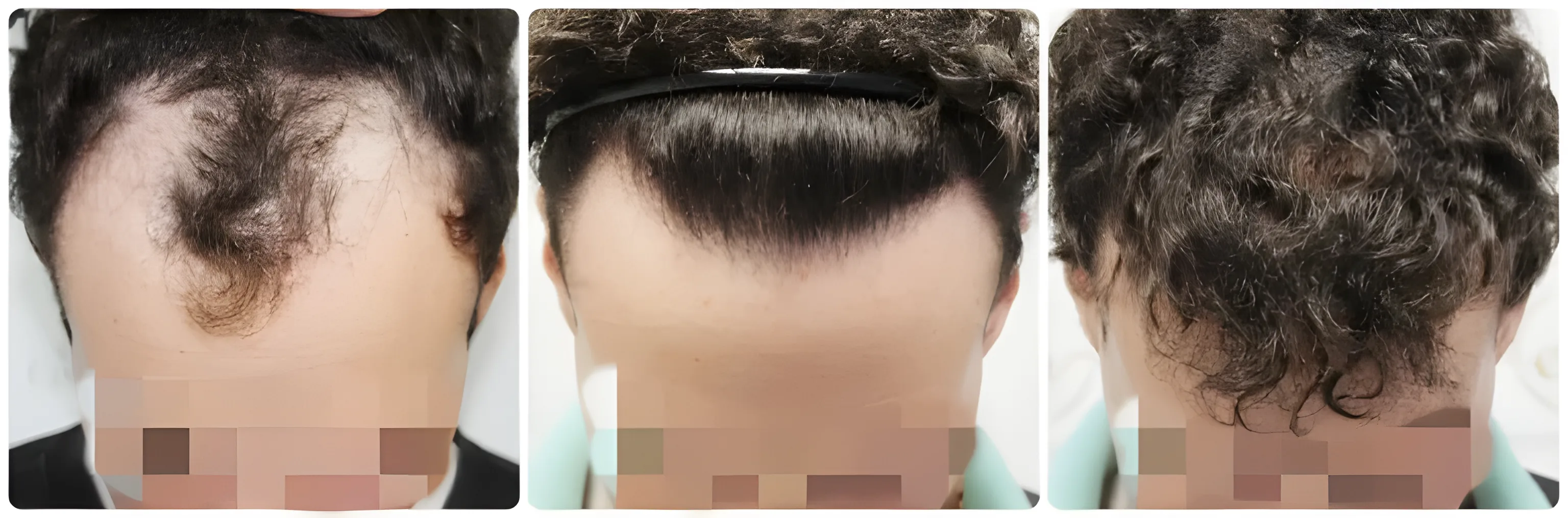 FUE hairline transplant — 2,050 grafts