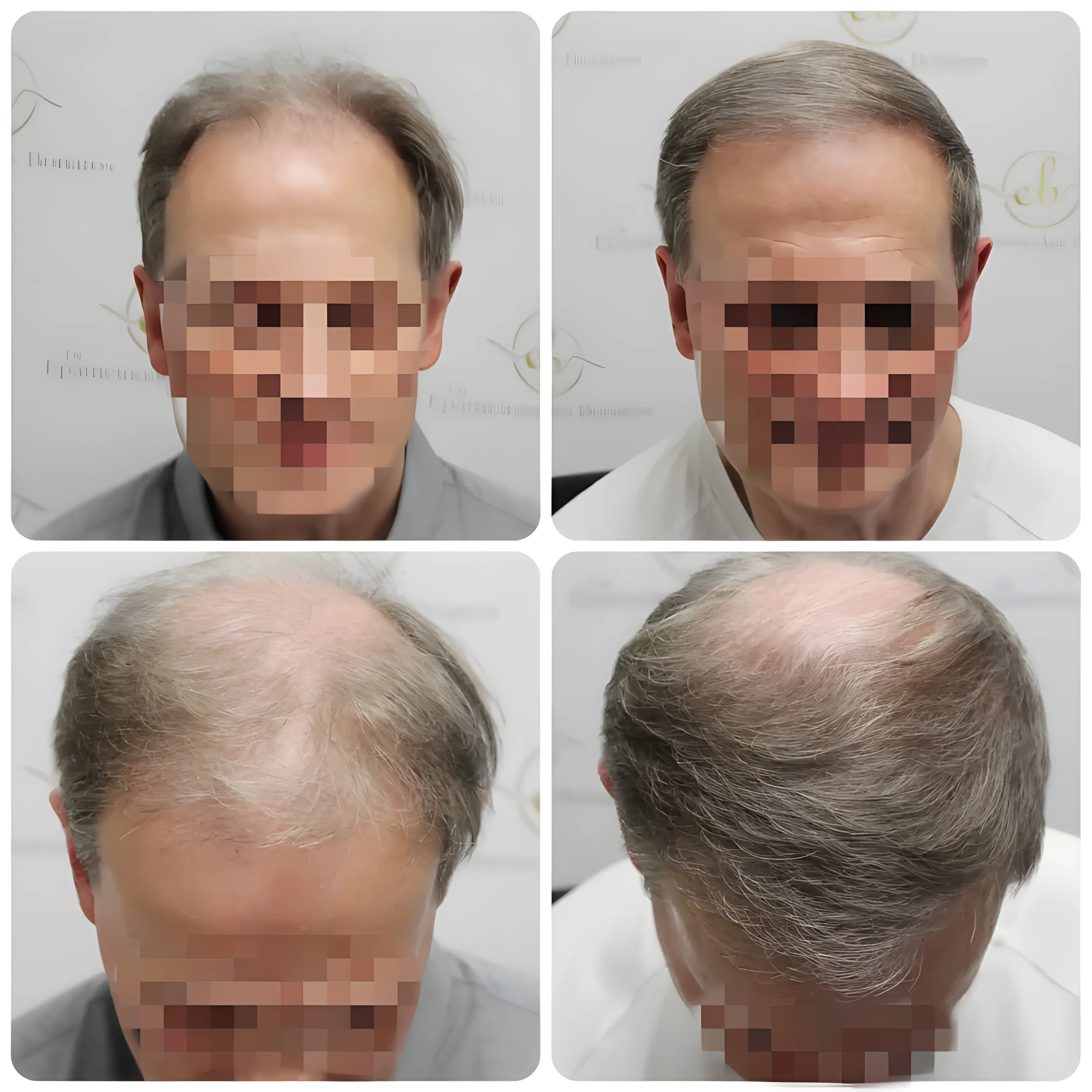 FUE frontal & mid-scalp — 1,954 grafts / 4,286 hairs