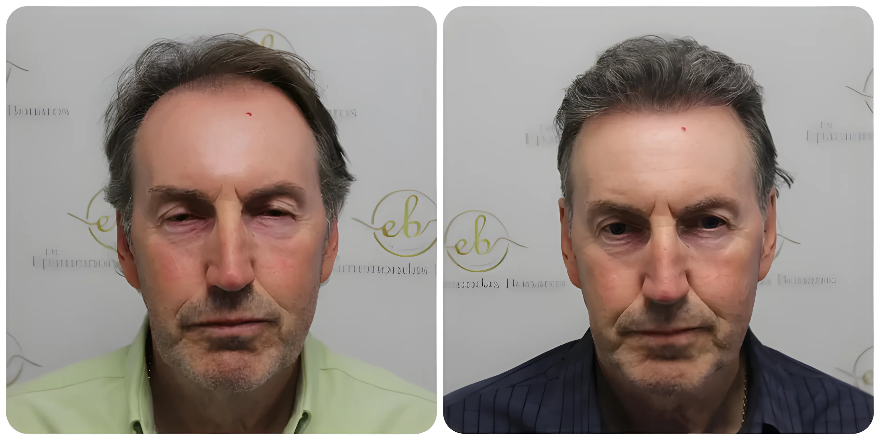 FUE hairline & crown — 3,500 grafts / 7,843 hairs
