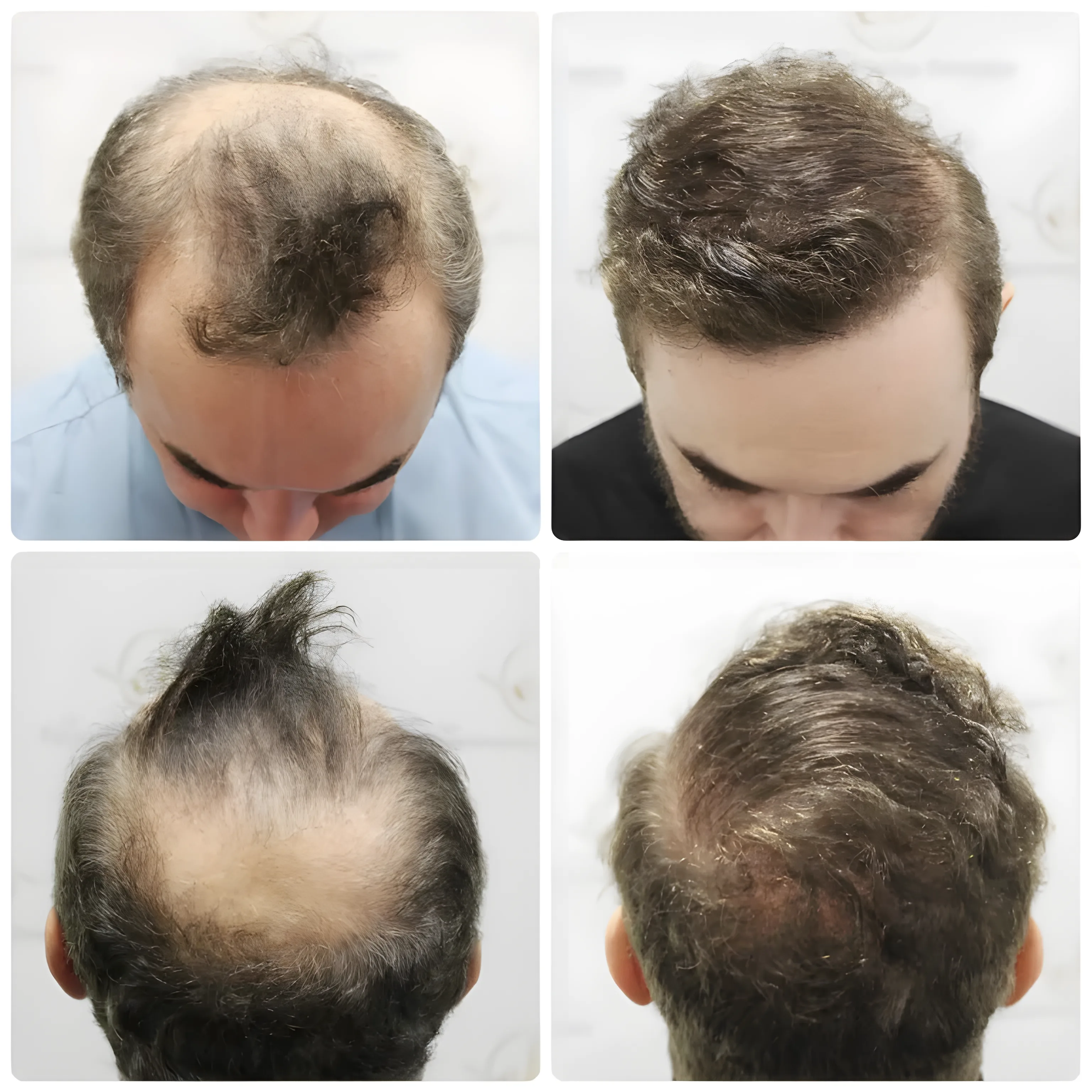 FUE hairline, crown & lateral humps — 3,986 grafts / 8,588 hairs