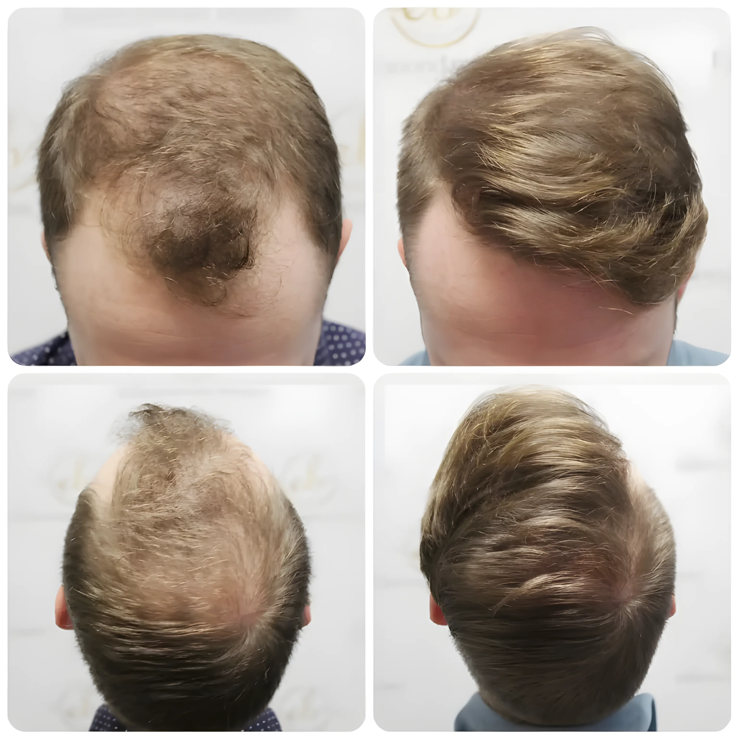 FUE hairline transplant — 1,819 grafts / 4,266 hairs