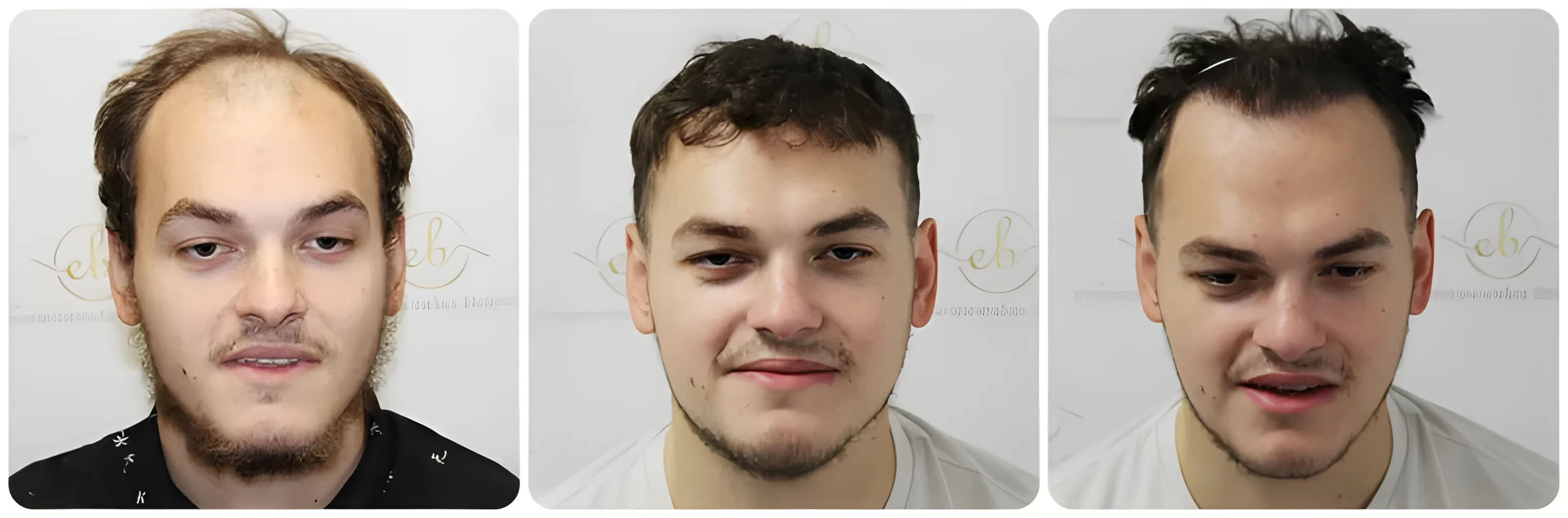 FUE receding hairline — 2,003 grafts / 4,390 hairs
