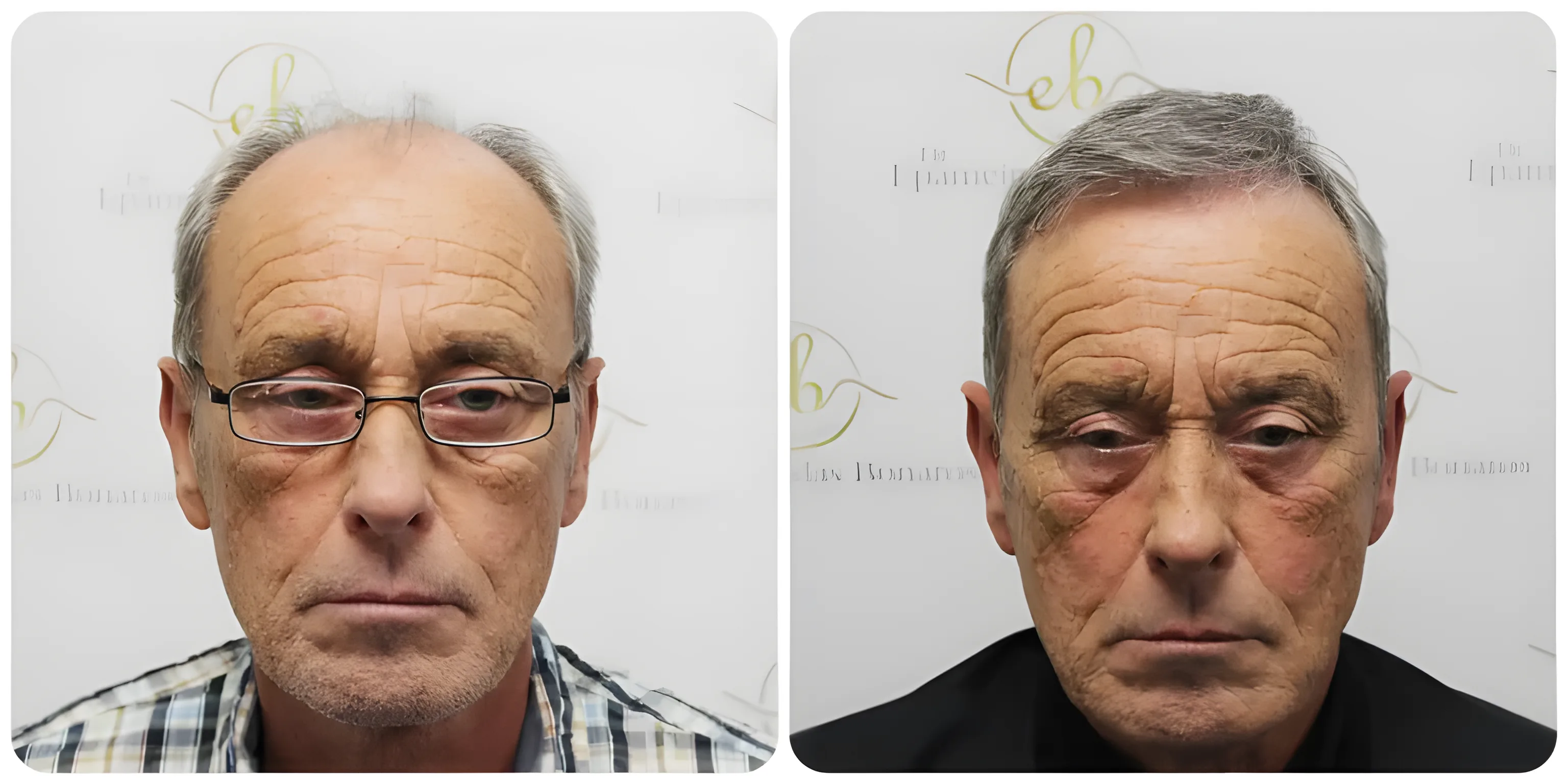FUE hairline & mid-scalp — 3,524 grafts / 7,610 hairs