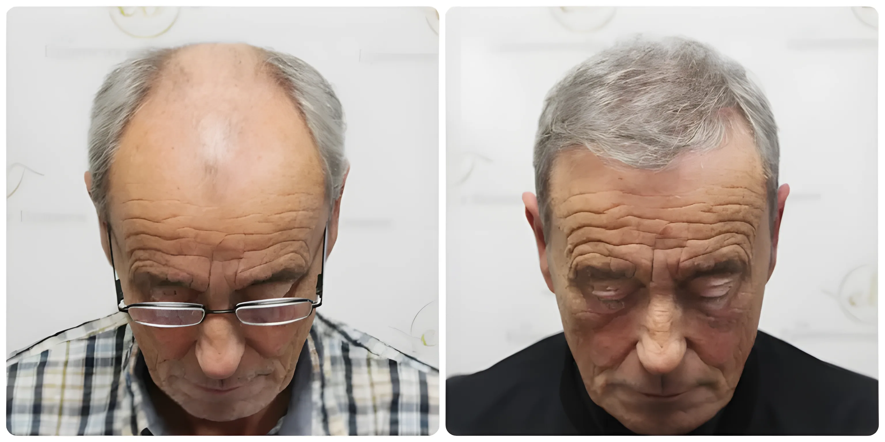 FUE hairline & mid-scalp — 3,524 grafts / 7,610 hairs