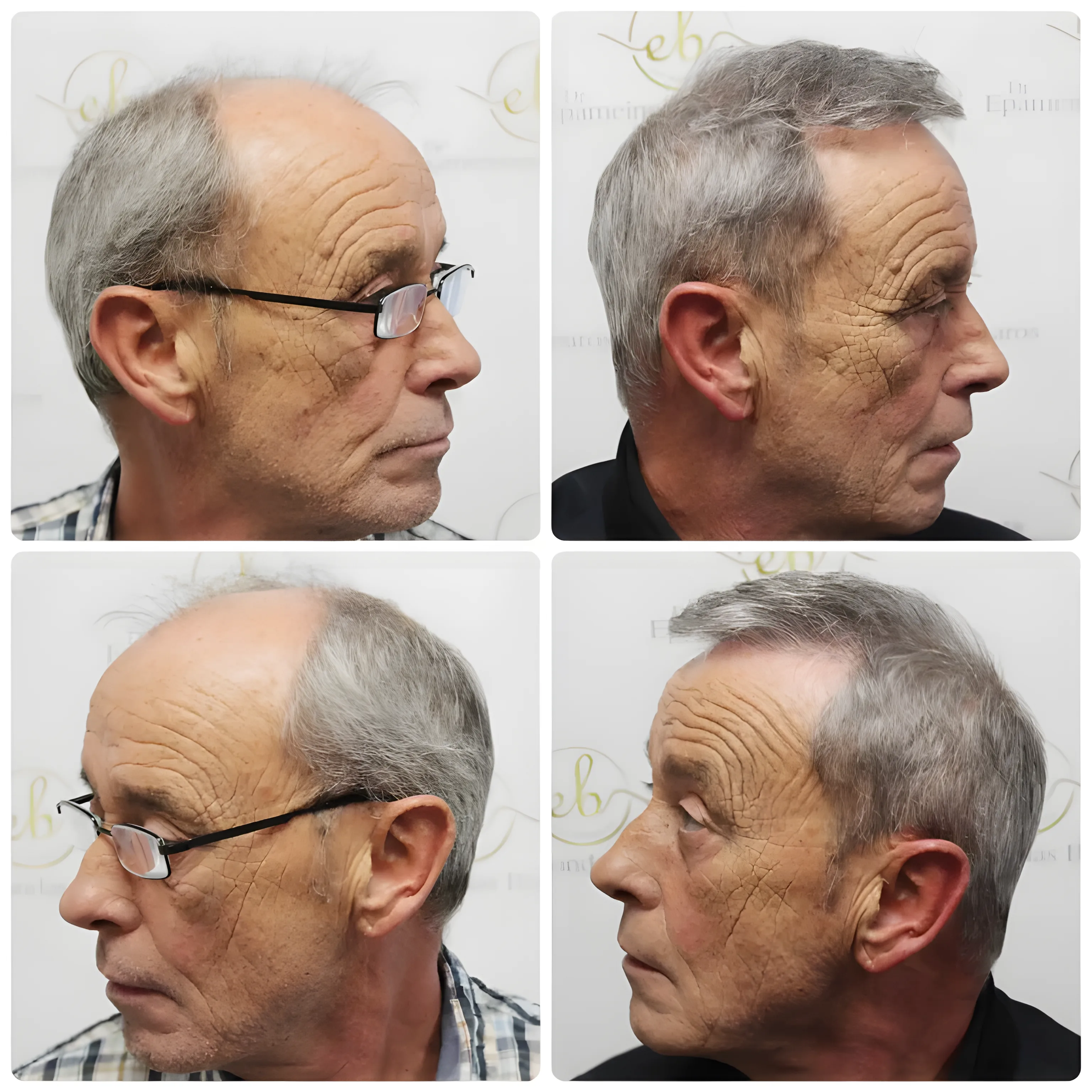 FUE hairline & mid-scalp — 3,524 grafts / 7,610 hairs