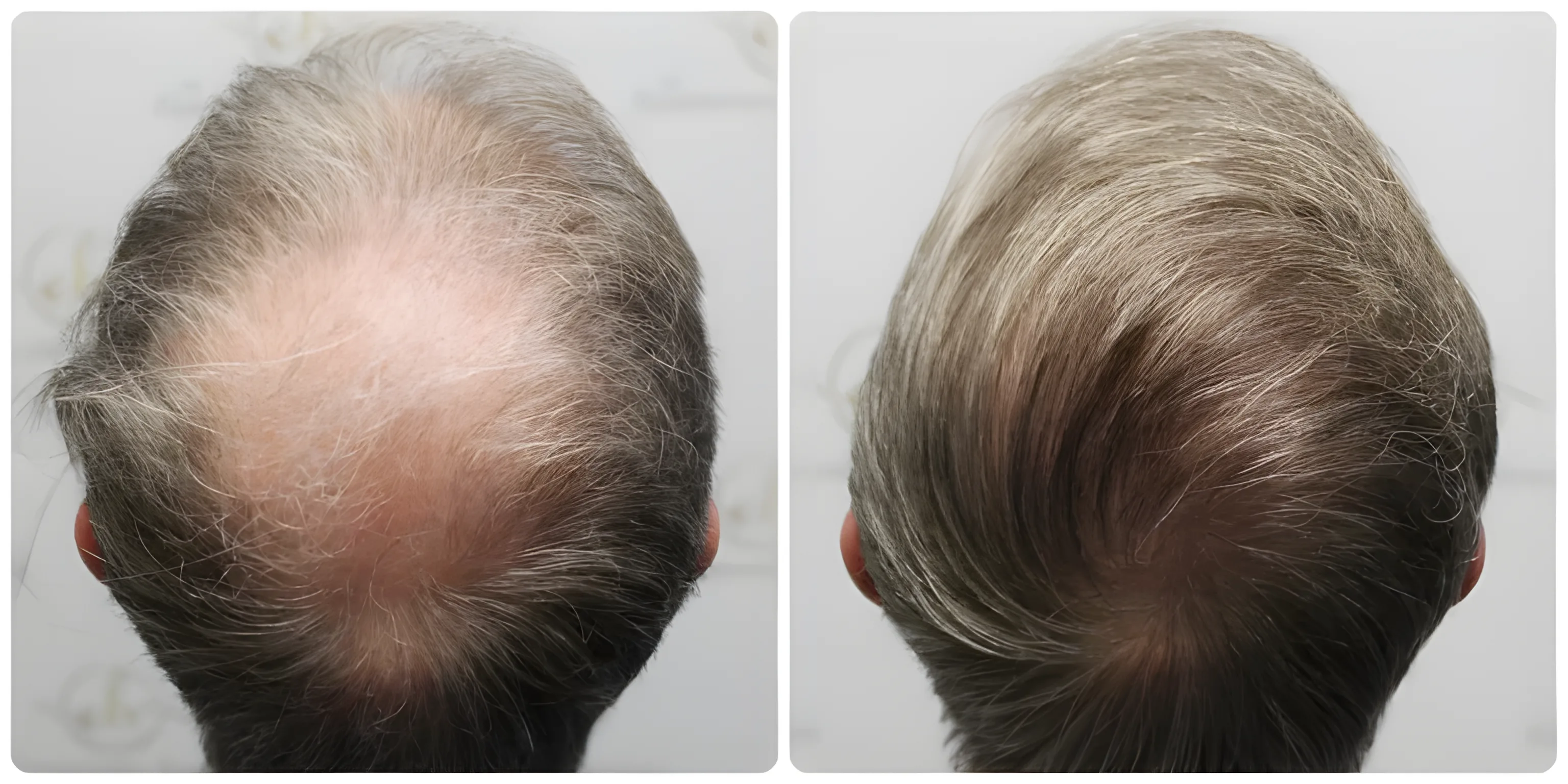 FUE hairline & crown — 3,700 grafts (two sessions)