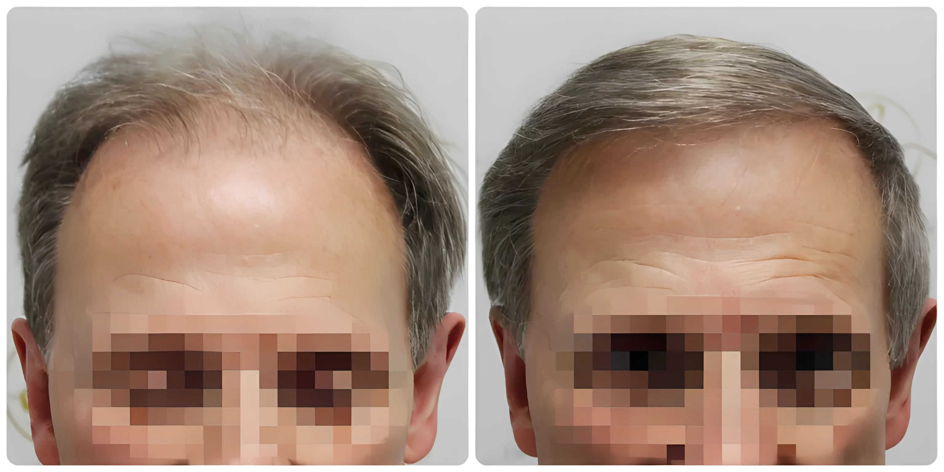 FUE hairline & crown — 3,700 grafts (two sessions)